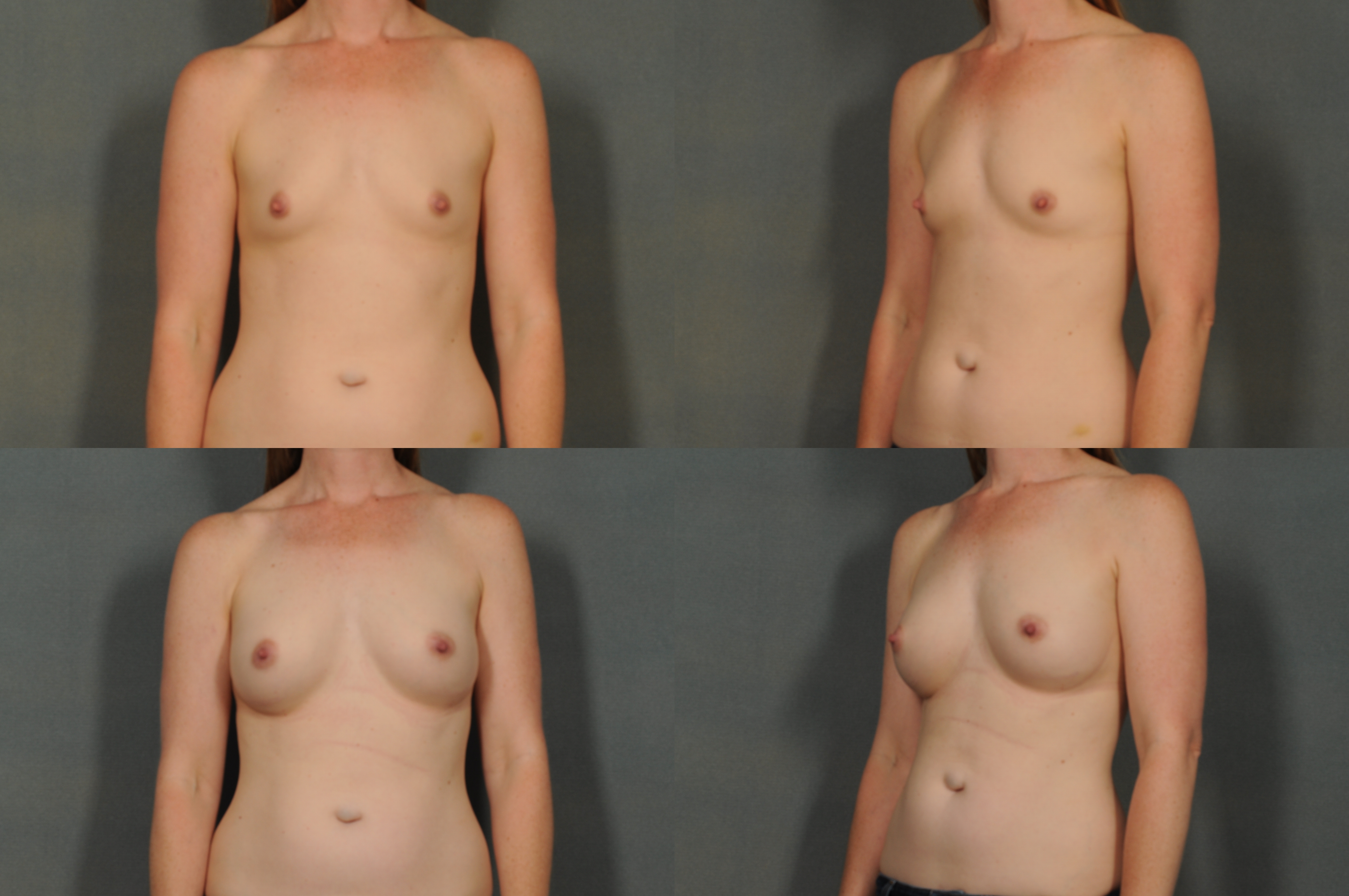 breast augmentation Dr. Ellen in Bloomfield Hills, MI