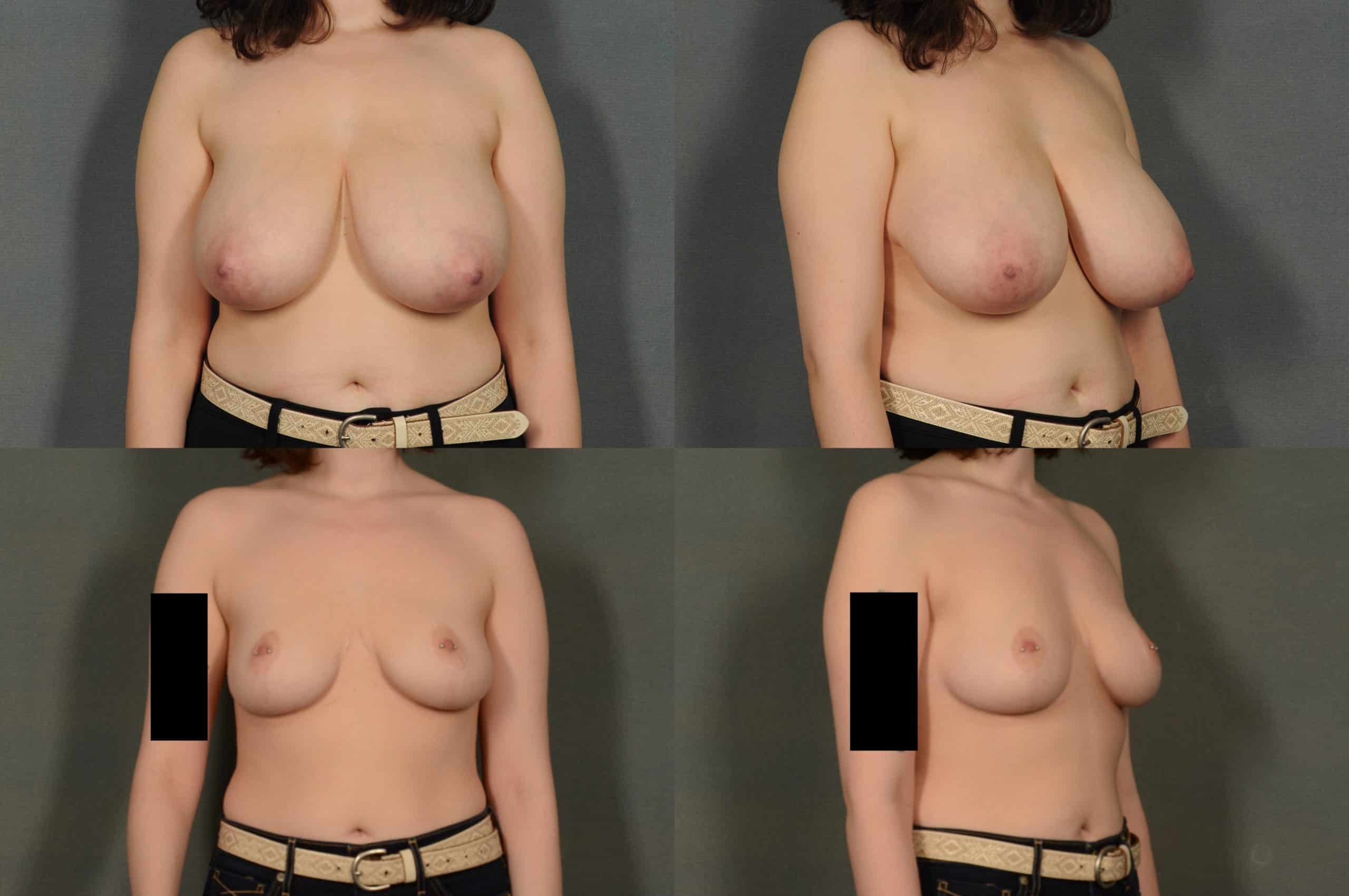 Breast Reduction Case# 957 Troy