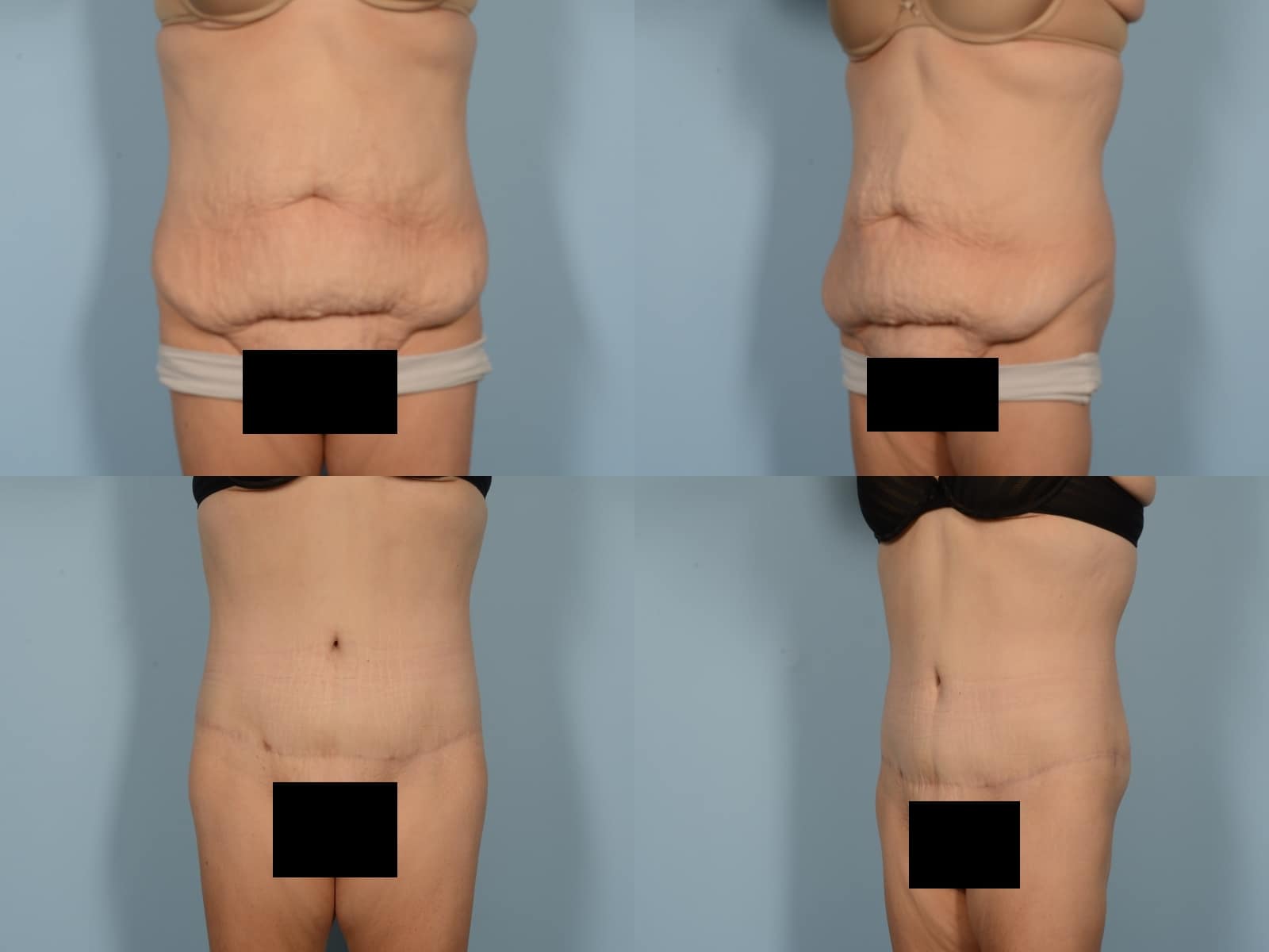 Tummy Tuck Case# 1174 Combined Image