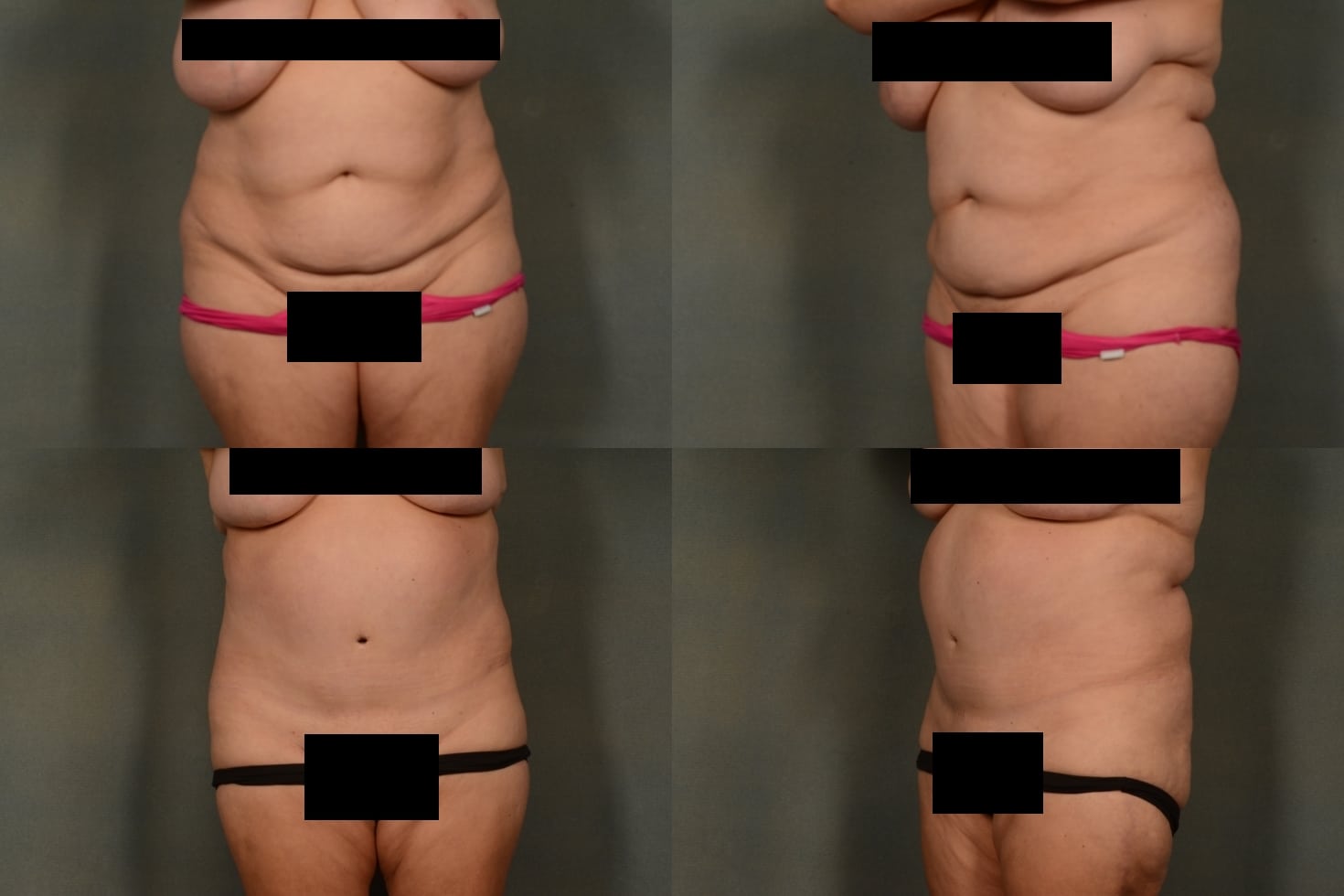 Tummy Tuck Case# 1000 Combined Image