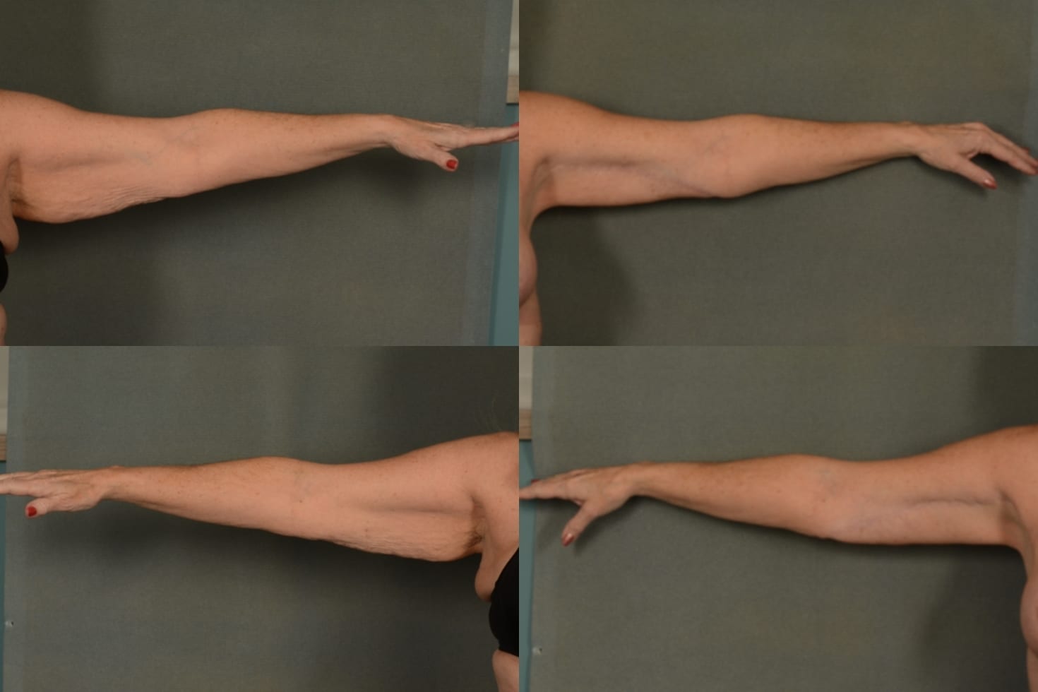 Arm Lift Case# 1019 Combined Image