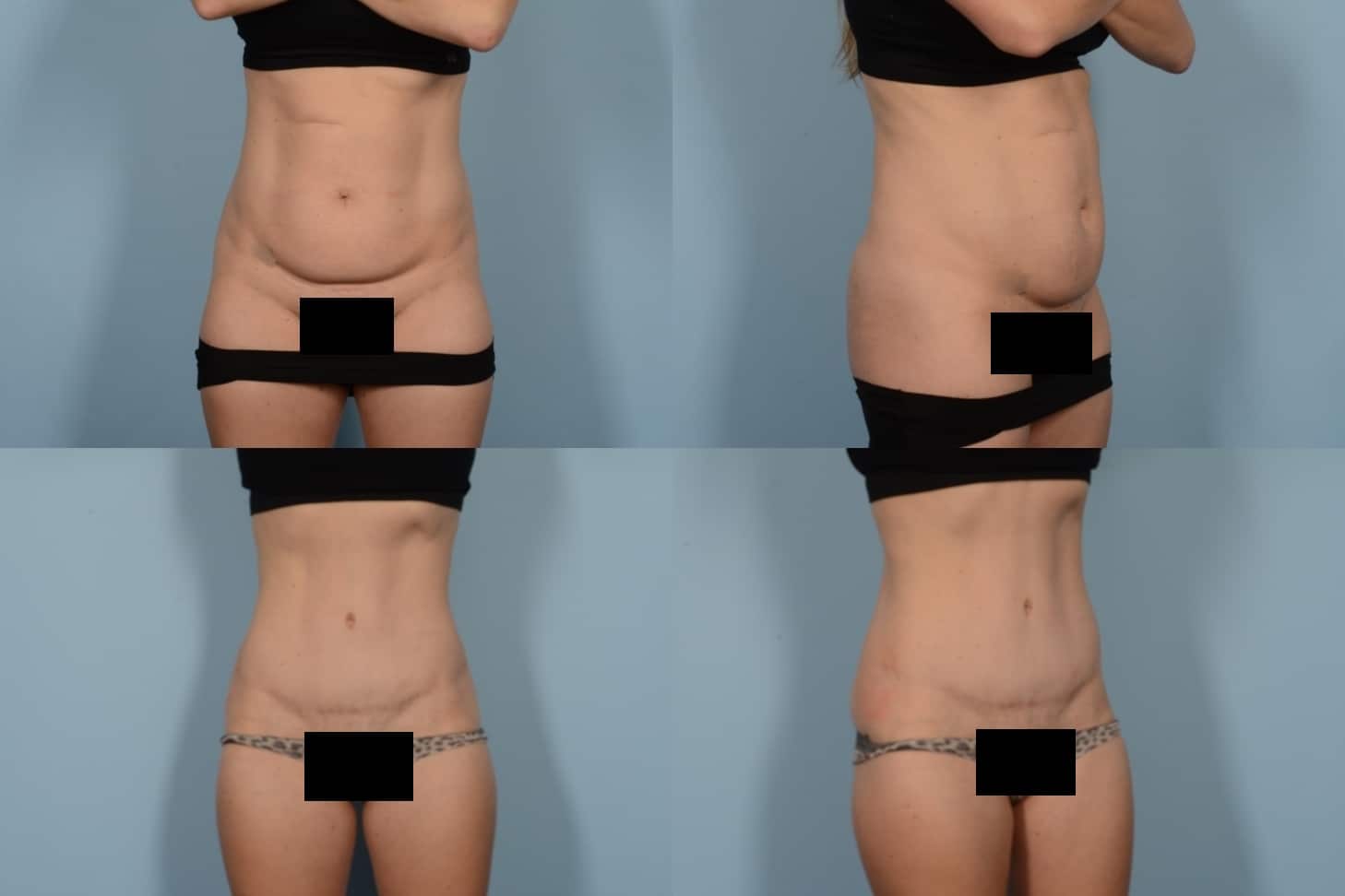 Tummy Tuck Case# 1148 Combined Image