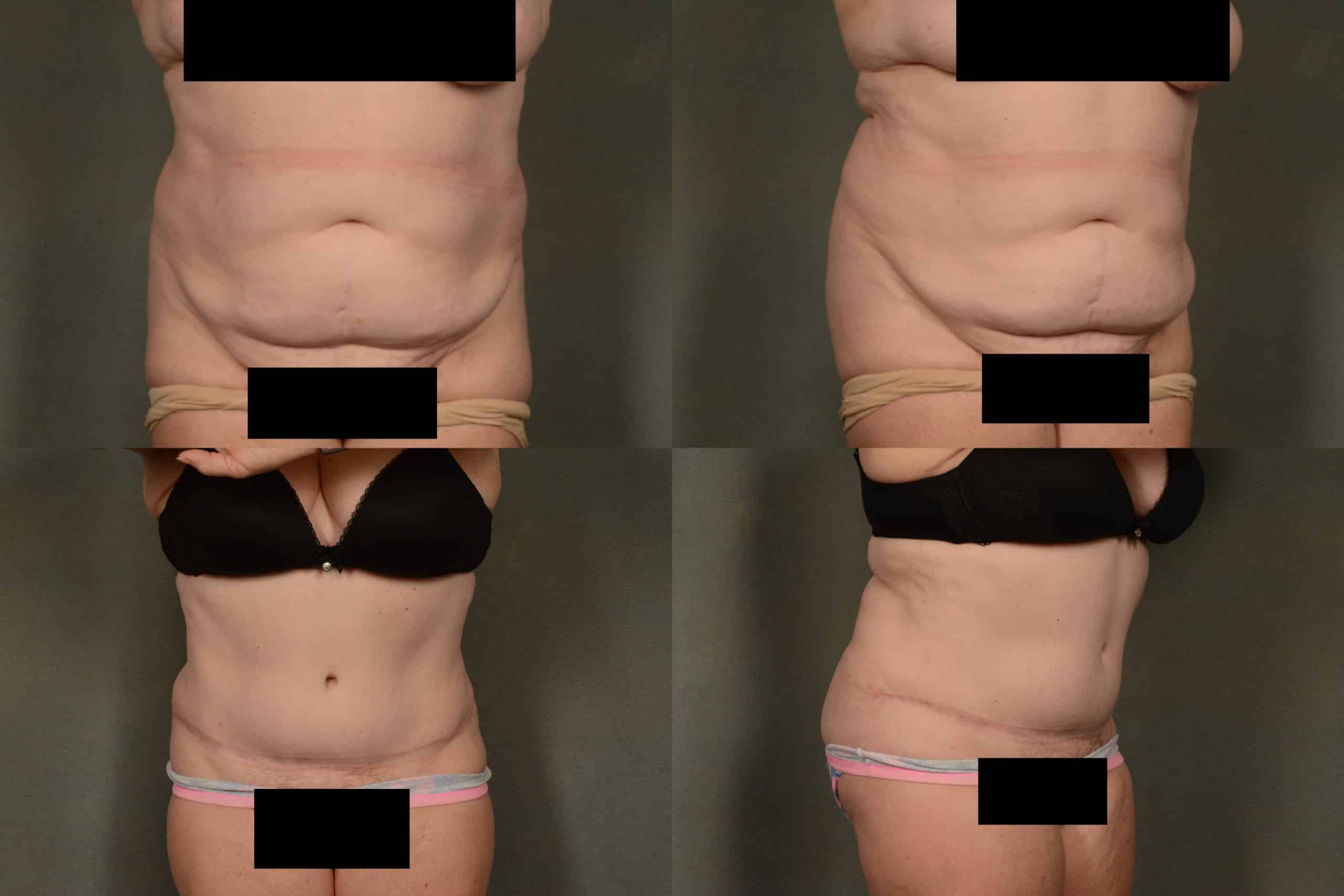 Tummy Tuck Case# 1026 Combined Image