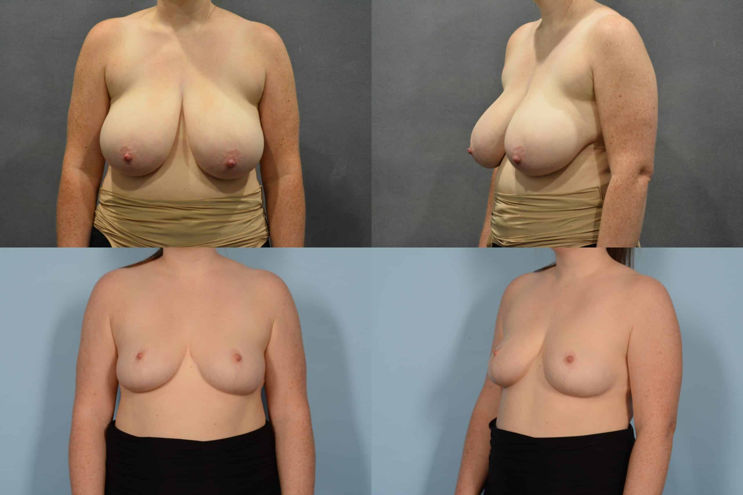 Breast Reduction Case# 1079 Combined Image