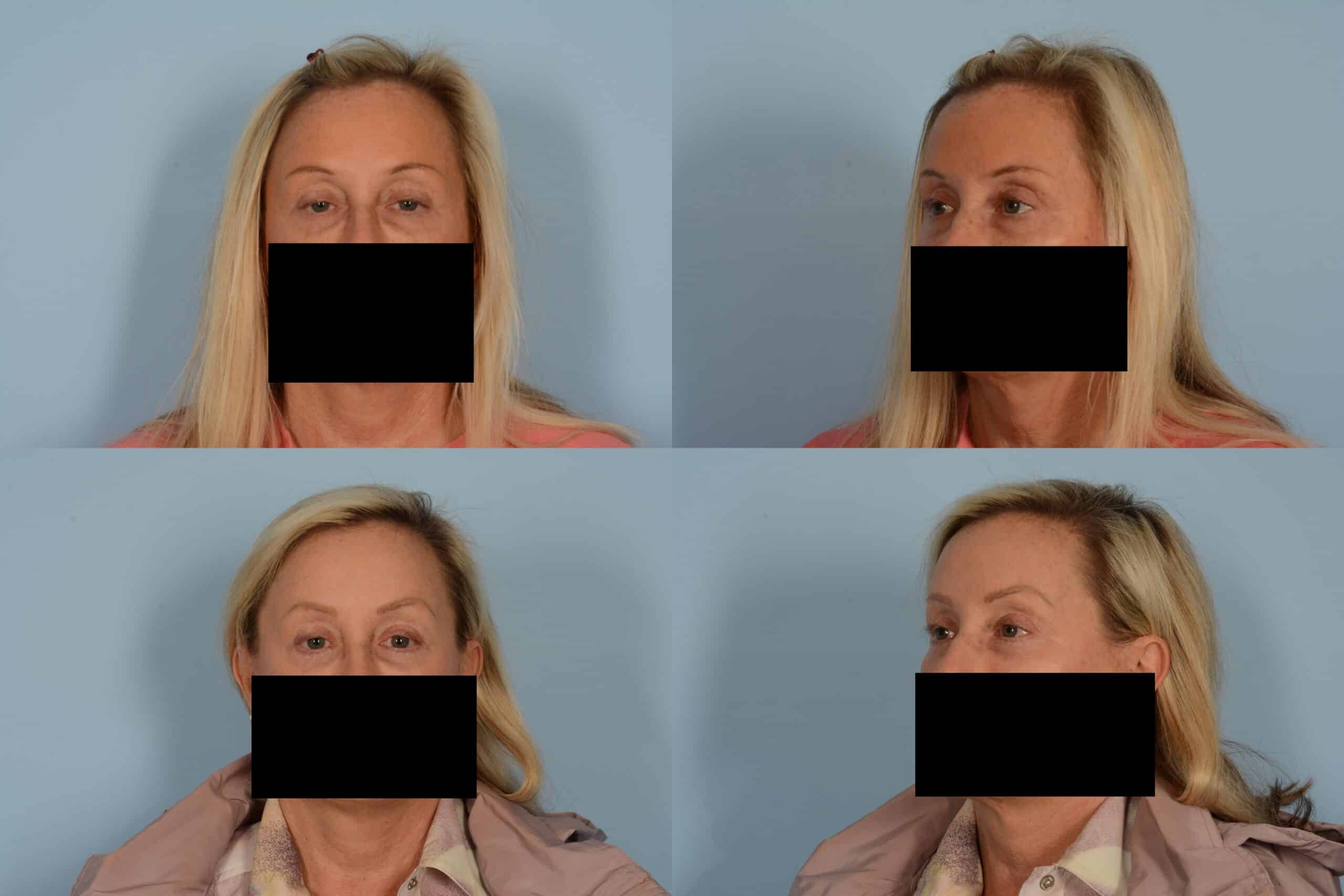 Blepharoplasty Case# 1139 Combined Image