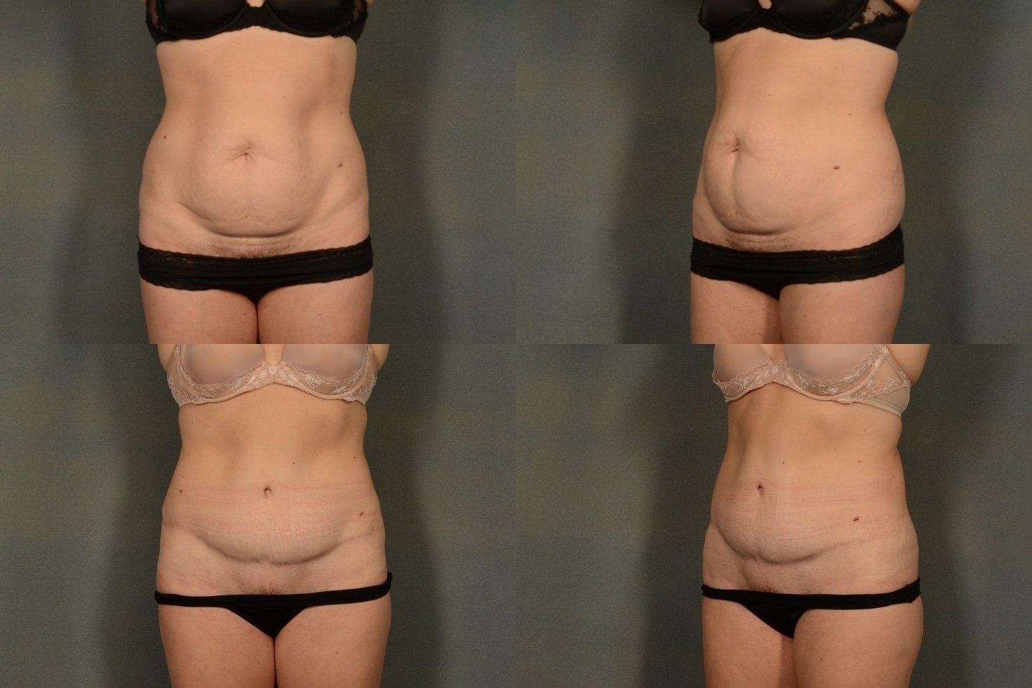 Tummy Tuck Case# 968 Combined Image