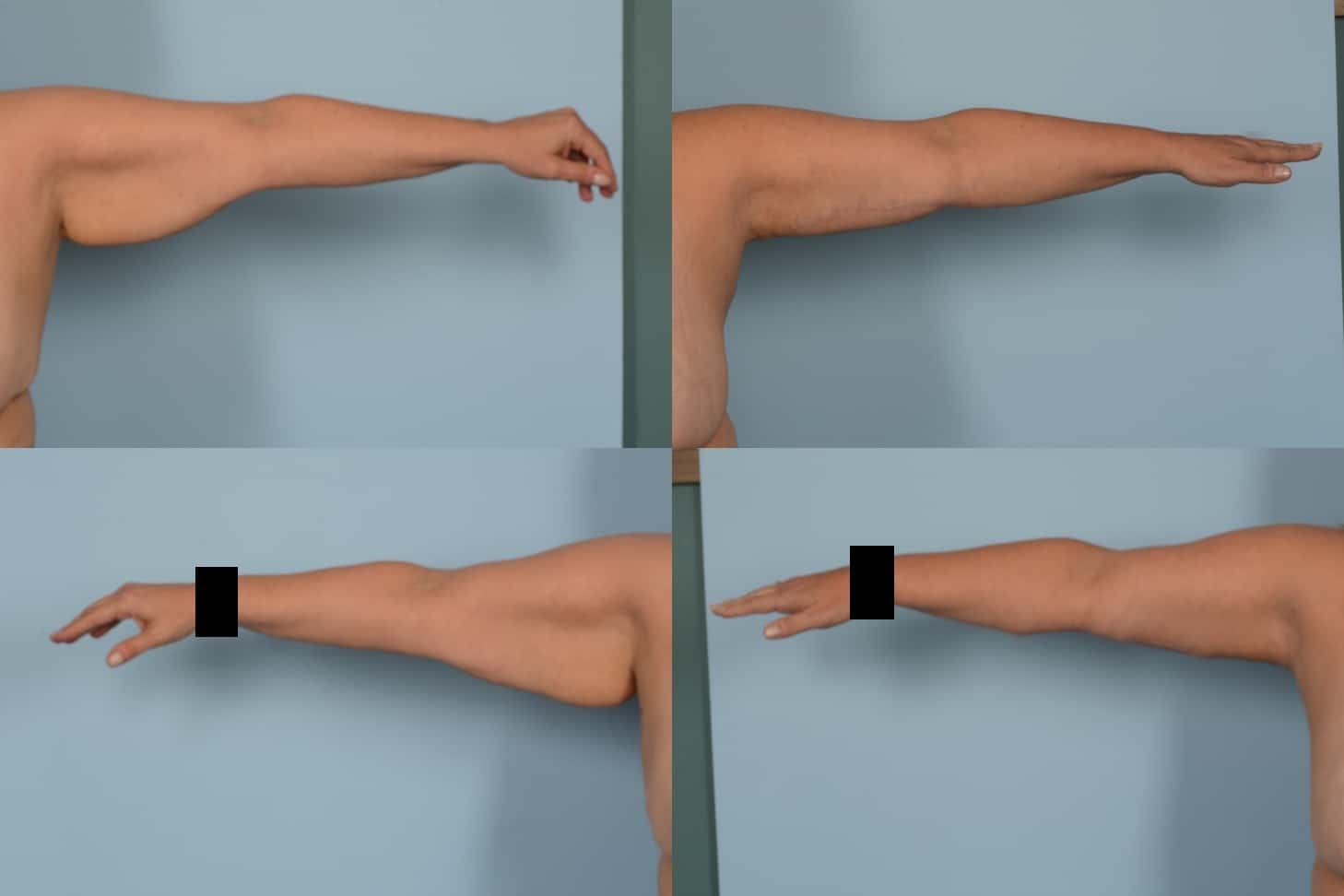 Arm Lift Case# 1127 Combined Image