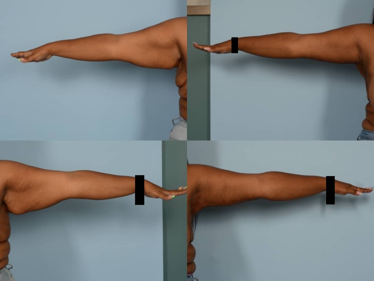 Arm Lift Case# 1165 Combined Image