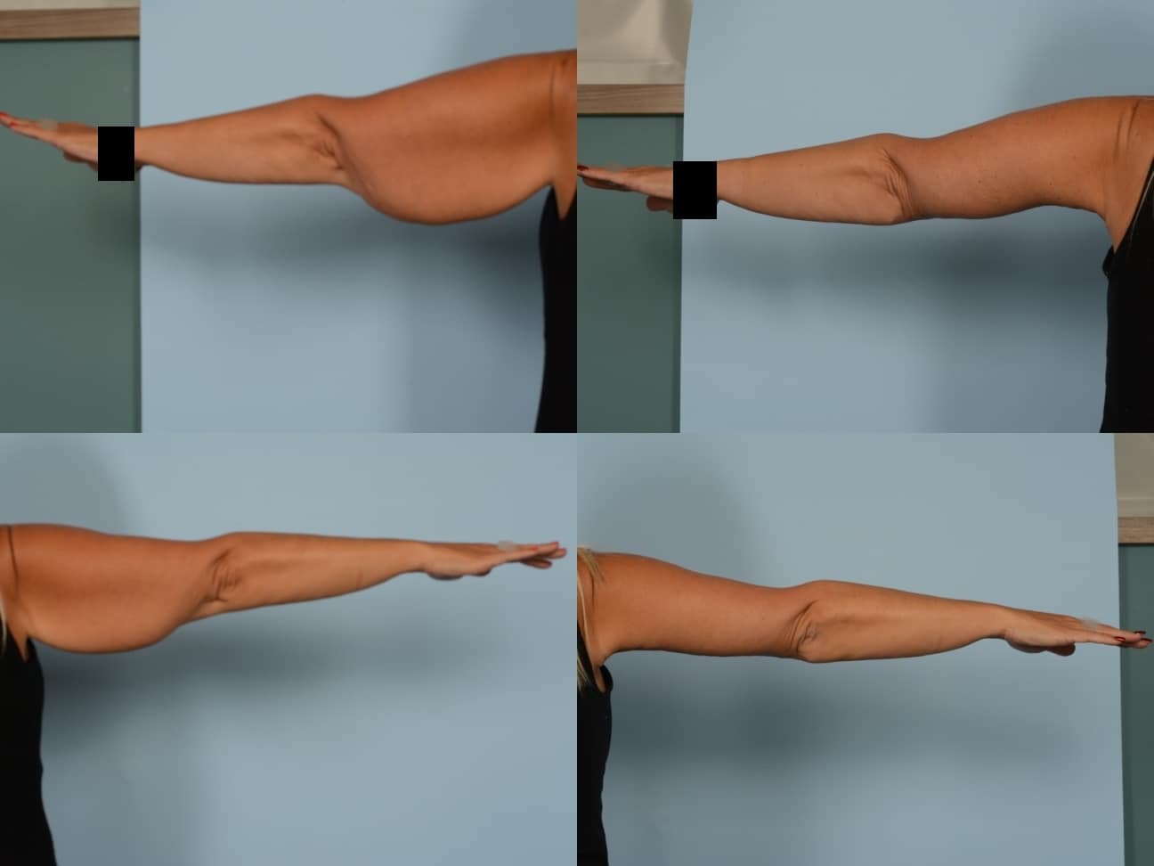 Arm Lift Case# 1176 Combined Image
