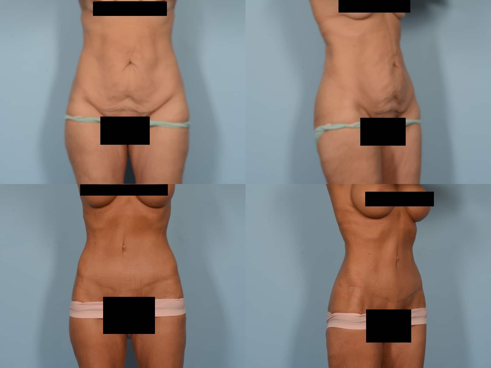 Tummy Tuck Case# 1202 Combined Image