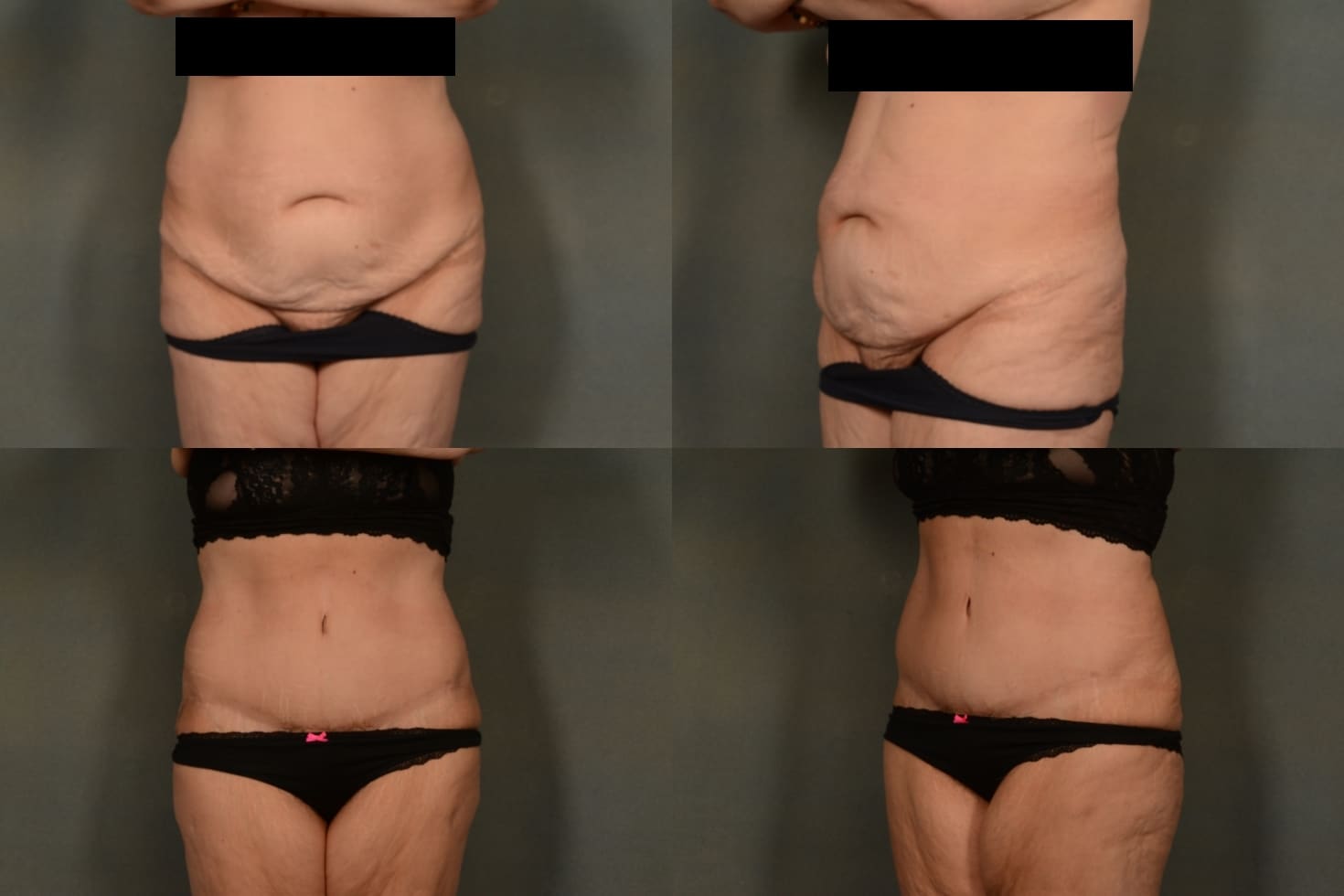 Tummy Tuck Case# 1006 Combined Image