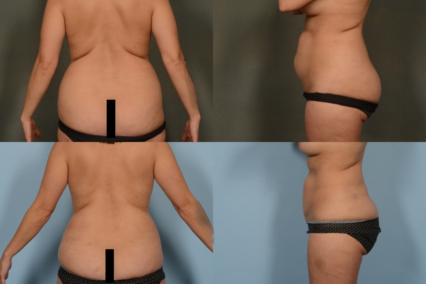 Liposuction Case# 1074 Combined Image