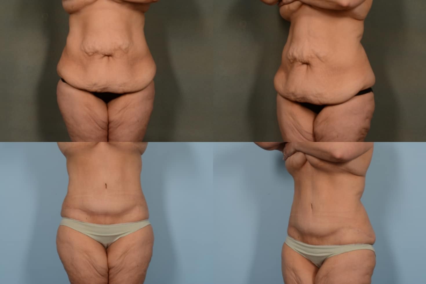 Tummy Tuck Case# 1080 Combined Image