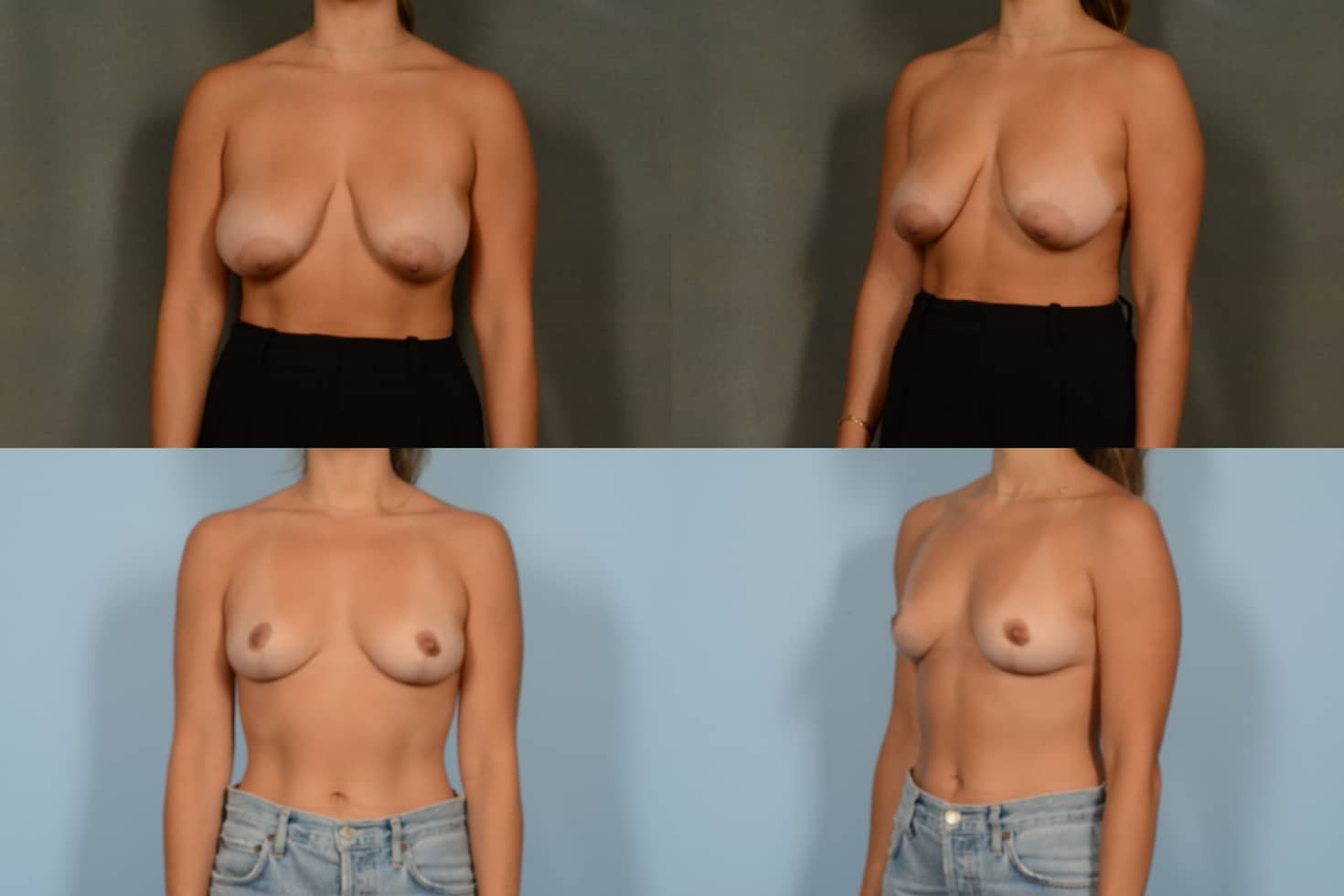 Breast Reduction Case # 1096 Combined Image