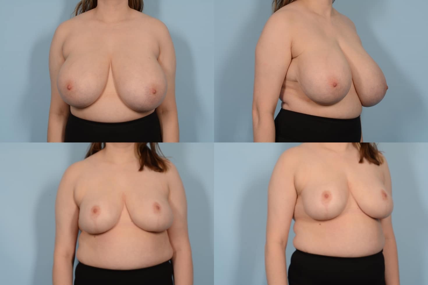 Breast Reduction Case# 1105 Combined Image