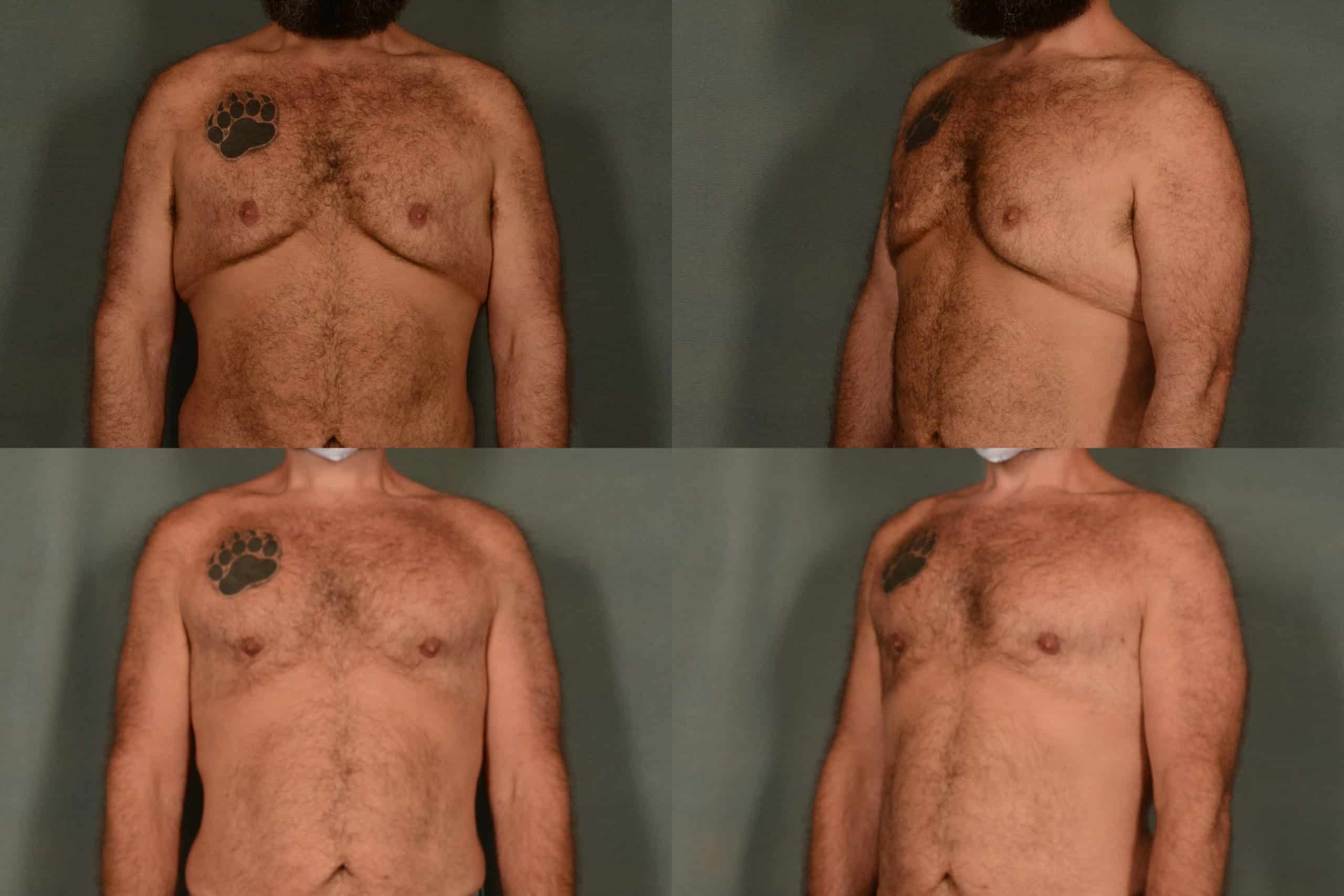 Male Breast Reduction Case# 962 Combined Image