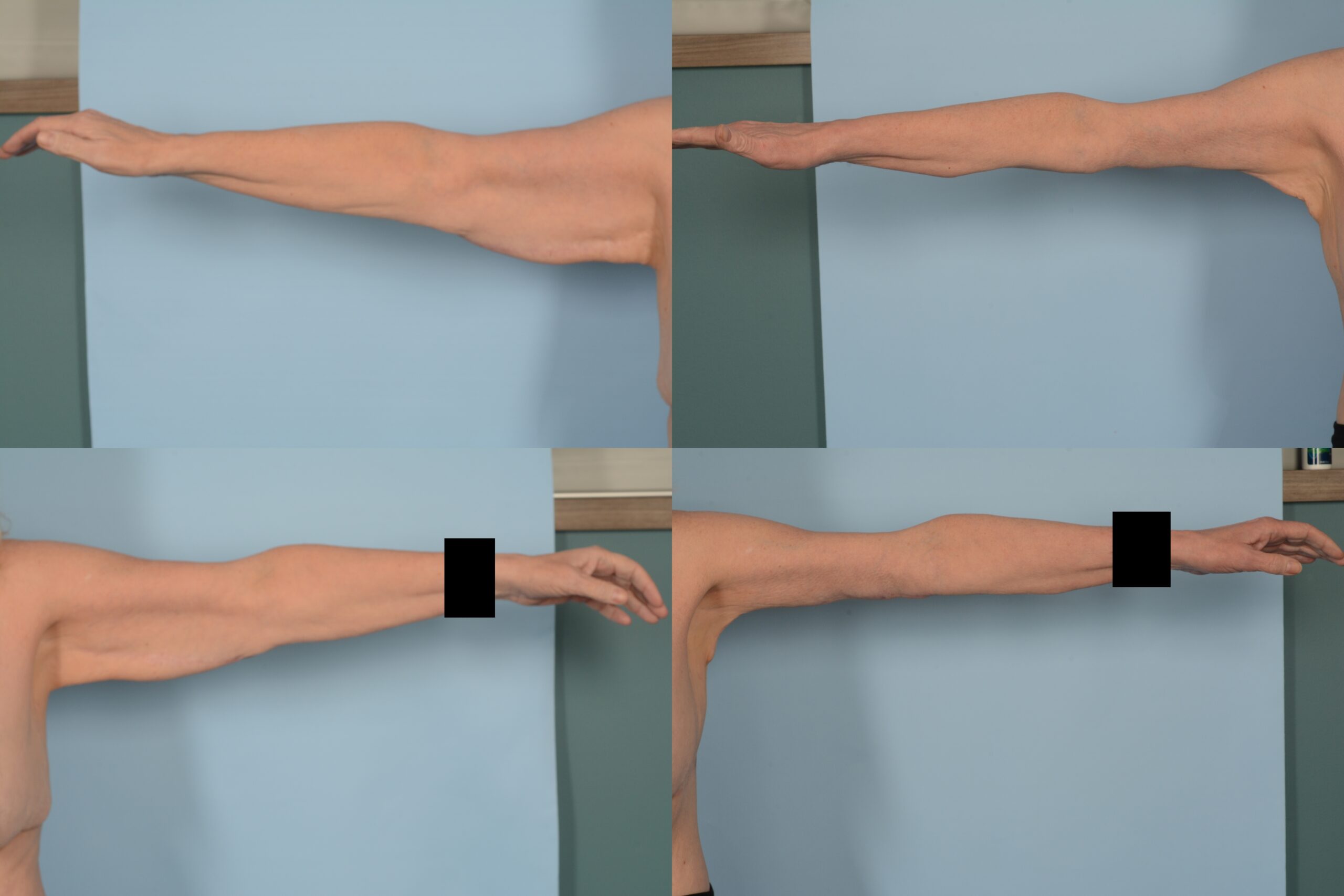 Arm Lift Case# 1109 Combined Image