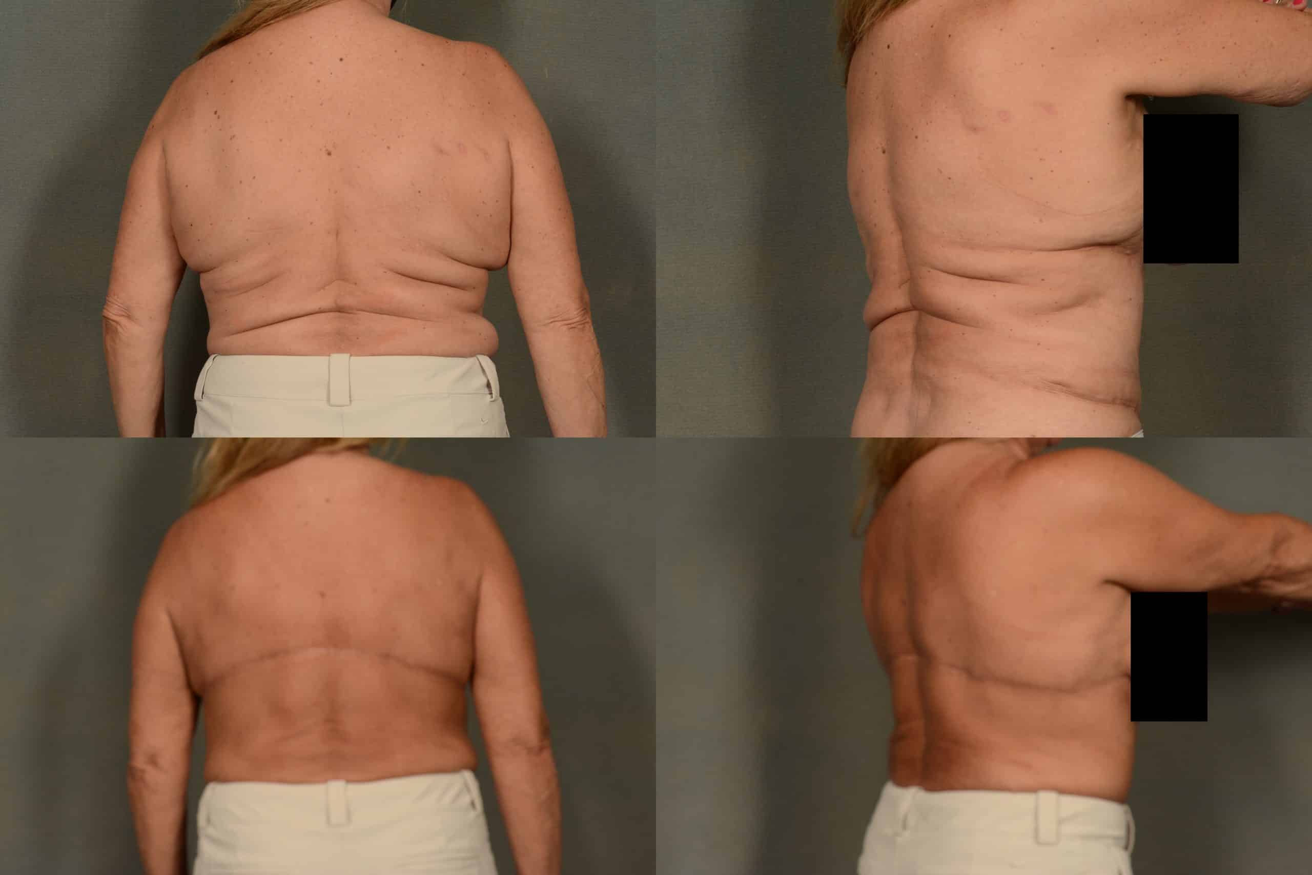 Back Lift Case# 1028 Combined Image