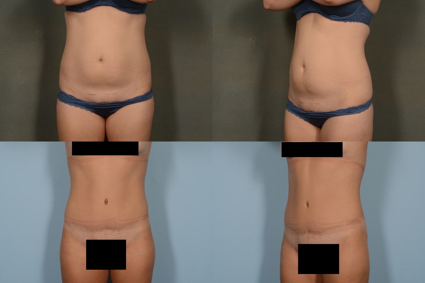 Tummy Tuck Case# 1102 Combined Image