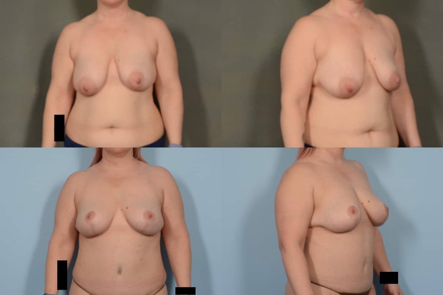 Breast Lift Case# 1084 Combined Image