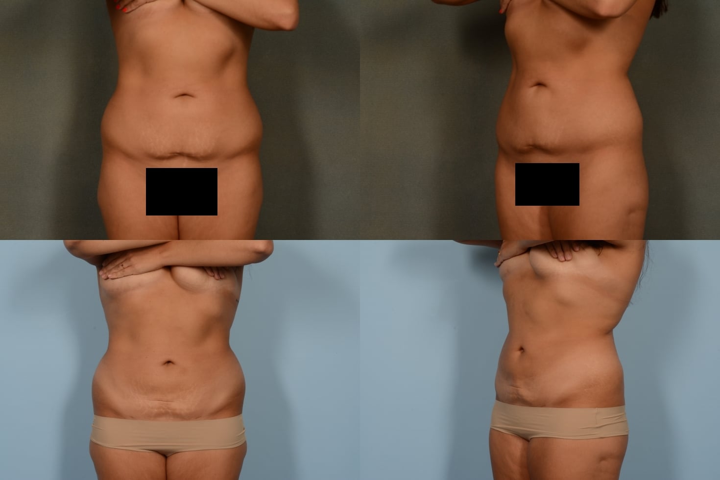 Liposuction Case# 1097 Combined Image