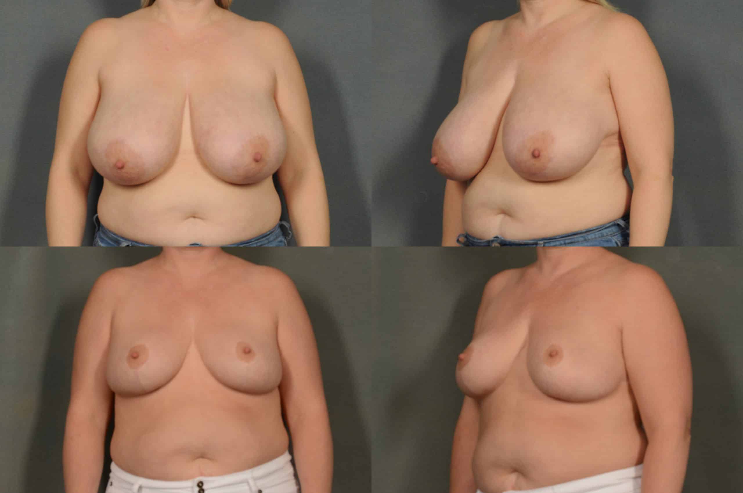 Breast Reduction Case# 966 Combined Image