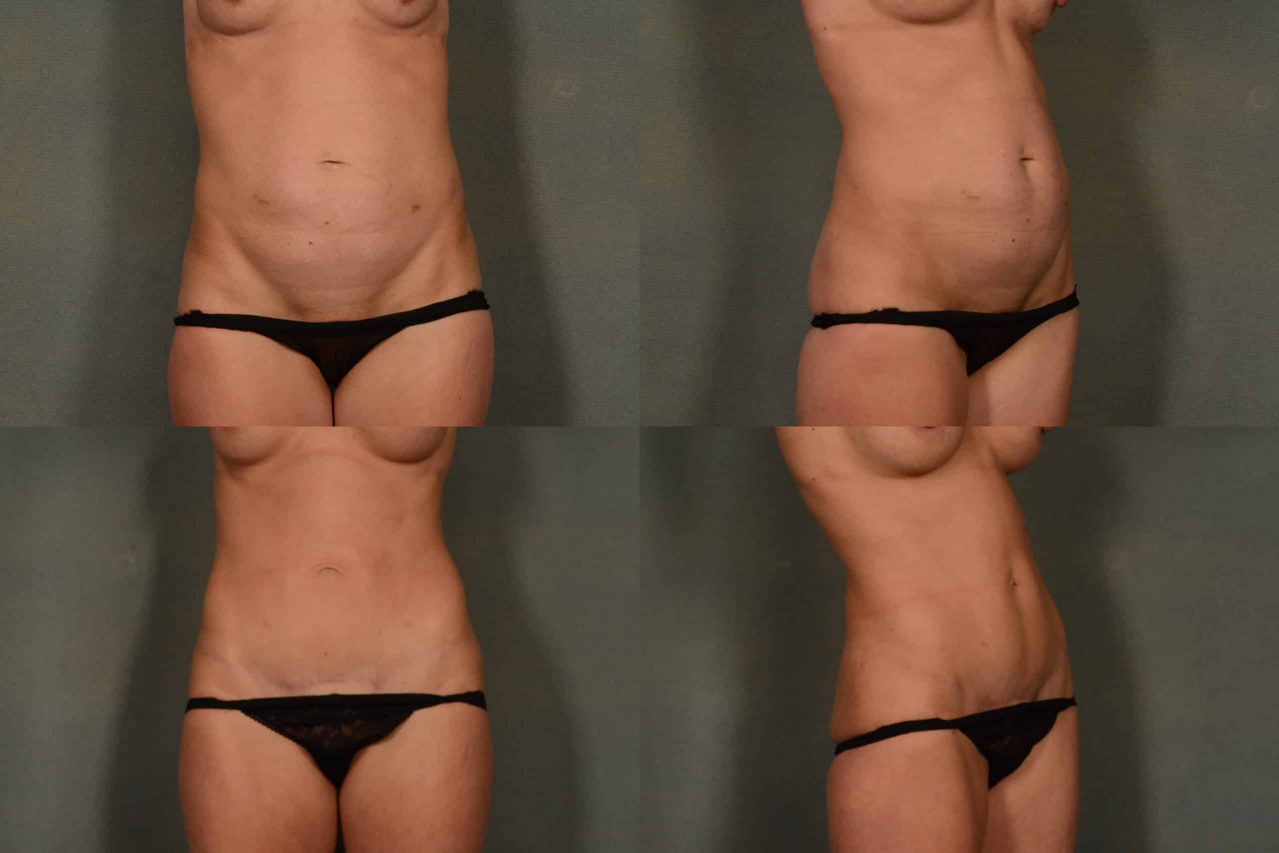 Tummy Tuck Mini Case# 969 Combined Image