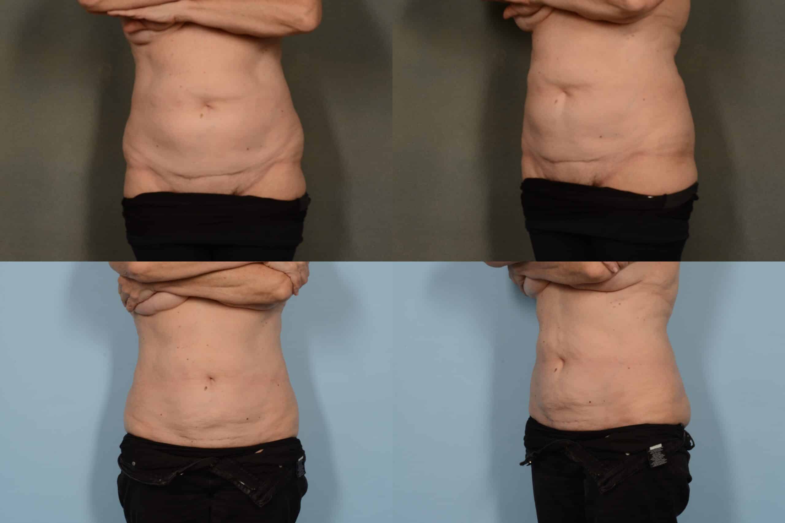 Liposuction Case# 1069 Combined Image