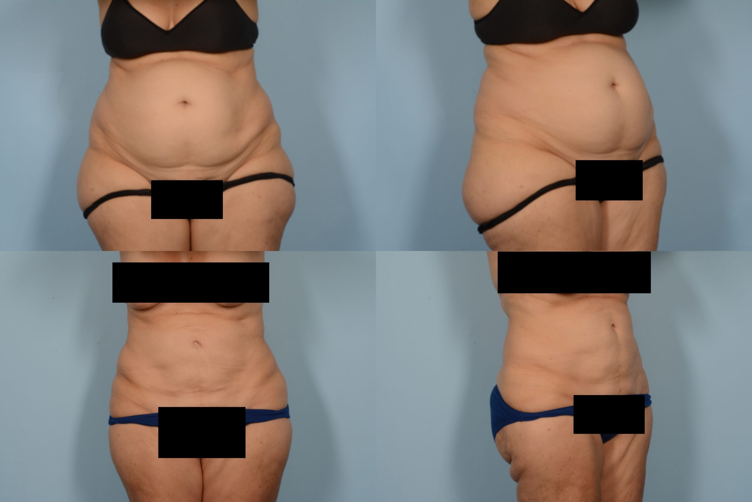 Liposuction Case# 1156 Combined Image
