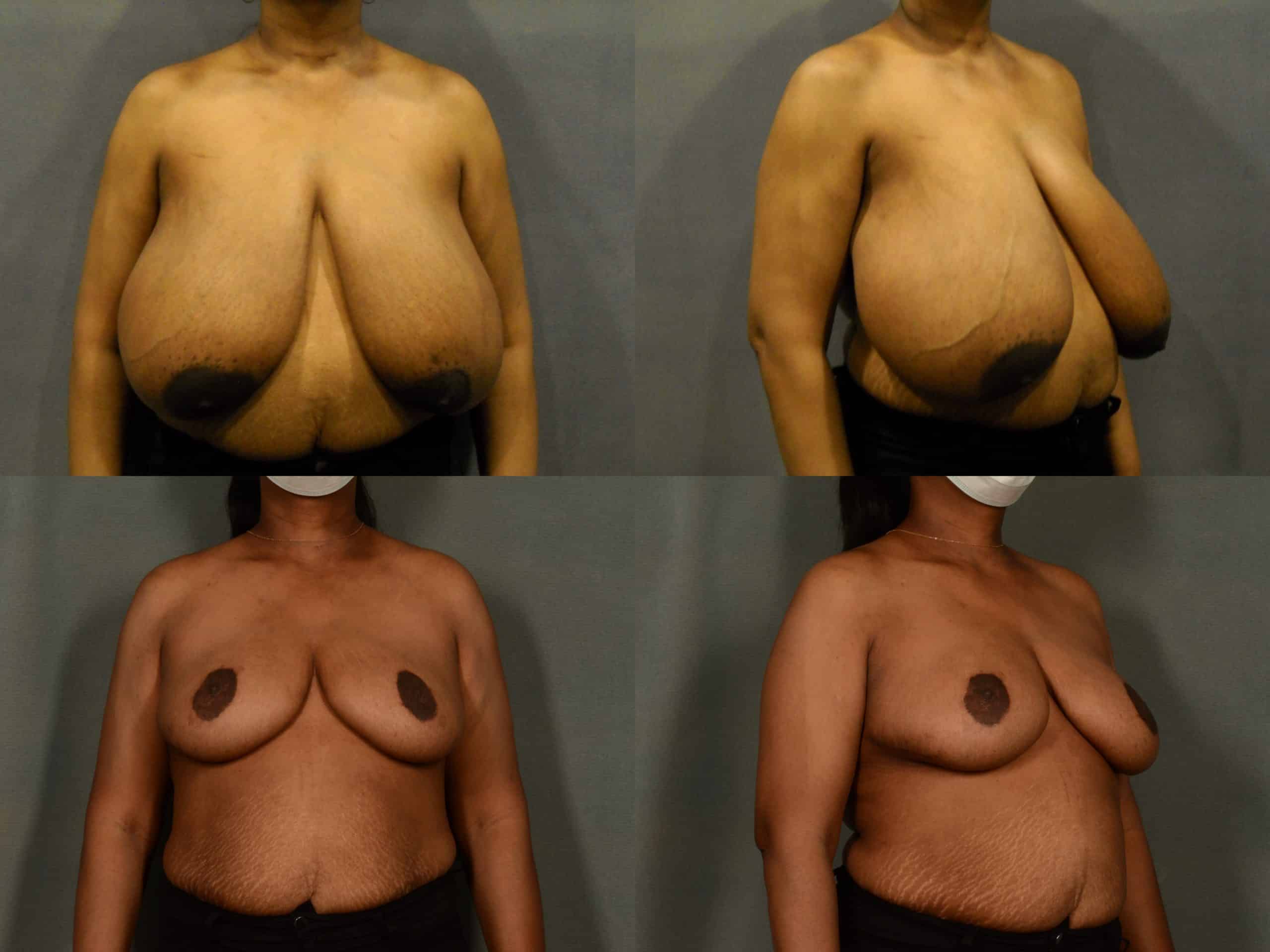 Breast Reduction Case# 964 Combined Image
