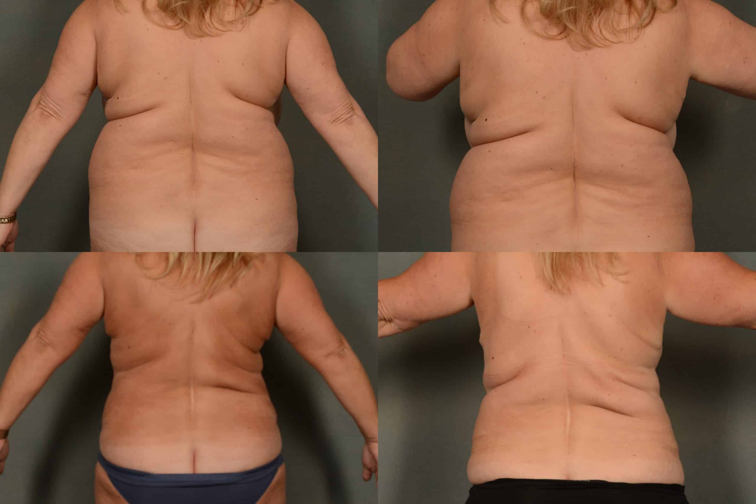 Liposuction Case# 980 Combined Image