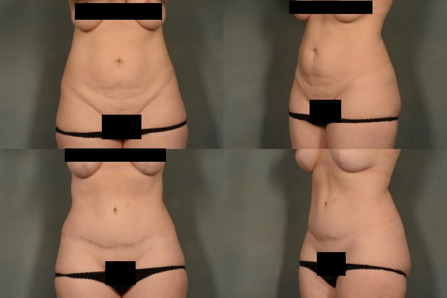 Tummy Tuck Case# 962 Combined Image