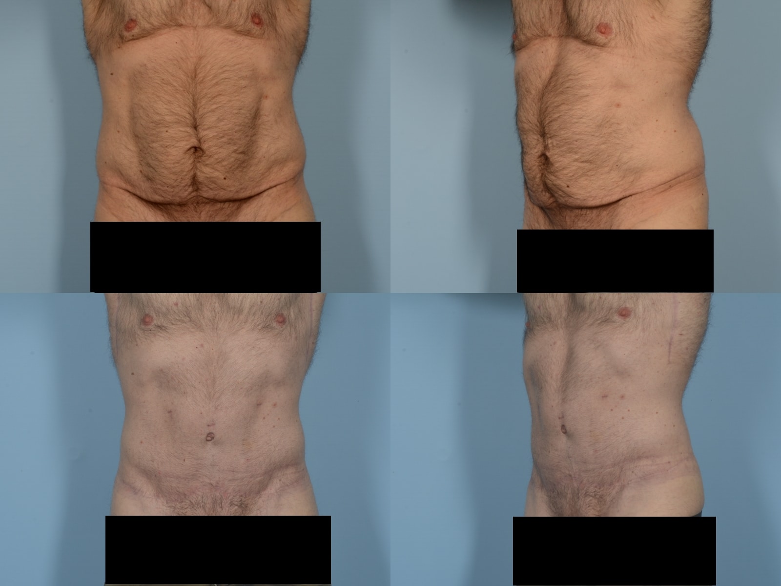 Tummy Tuck Case# 1185 Combined Image
