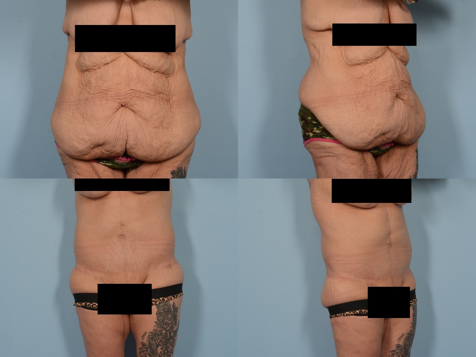 Tummy Tuck Case# 1201 Combined Image