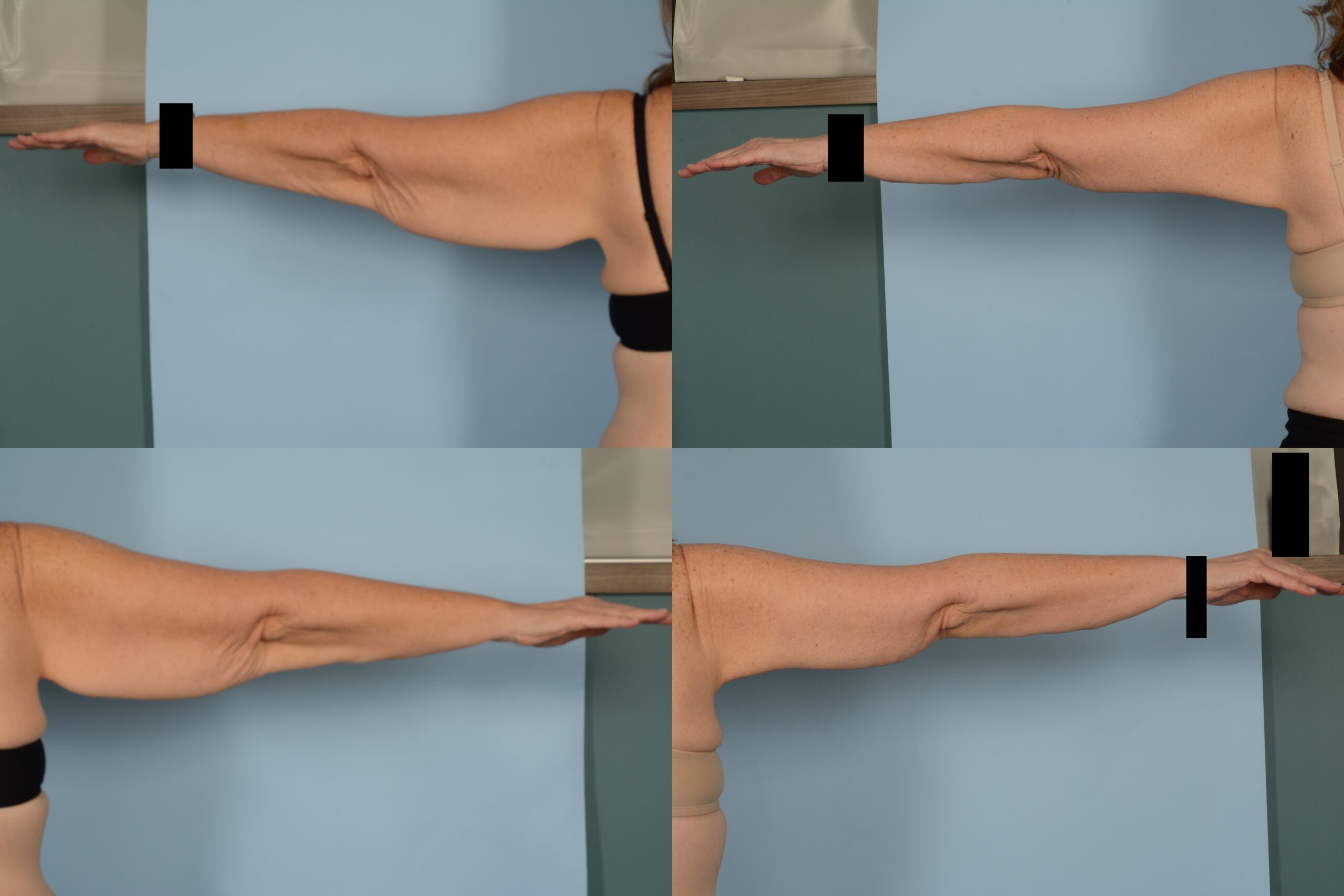 Arm Lift Case# 1107 Combined Image