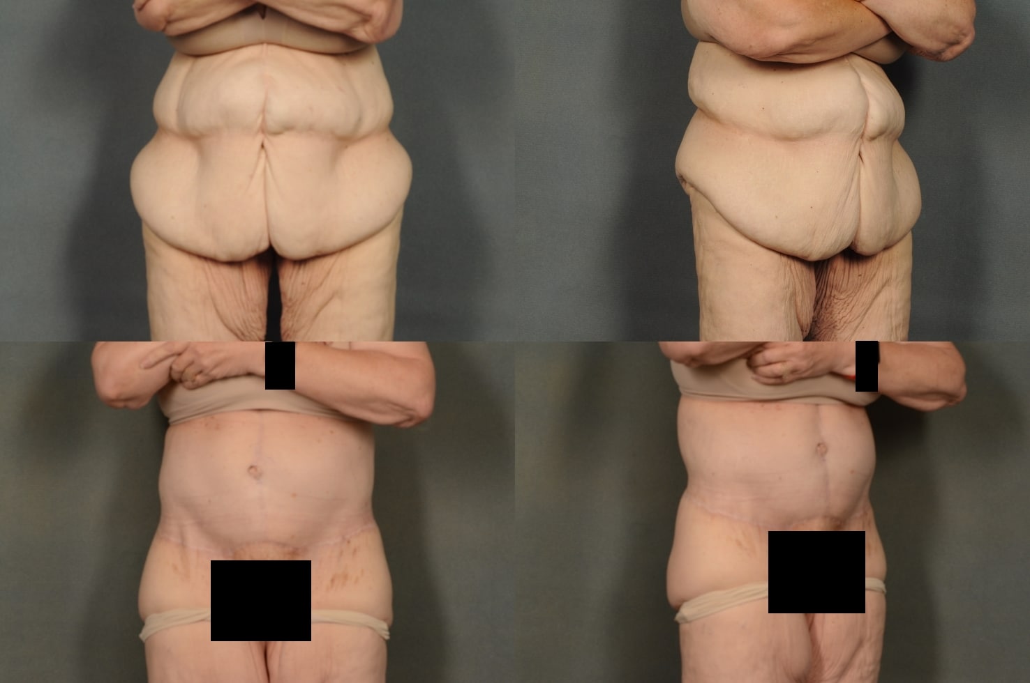 Tummy Tuck Case# 972 Combined Image