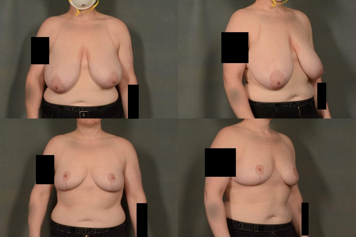 Breast Reduction Case# 1025 Combined Image