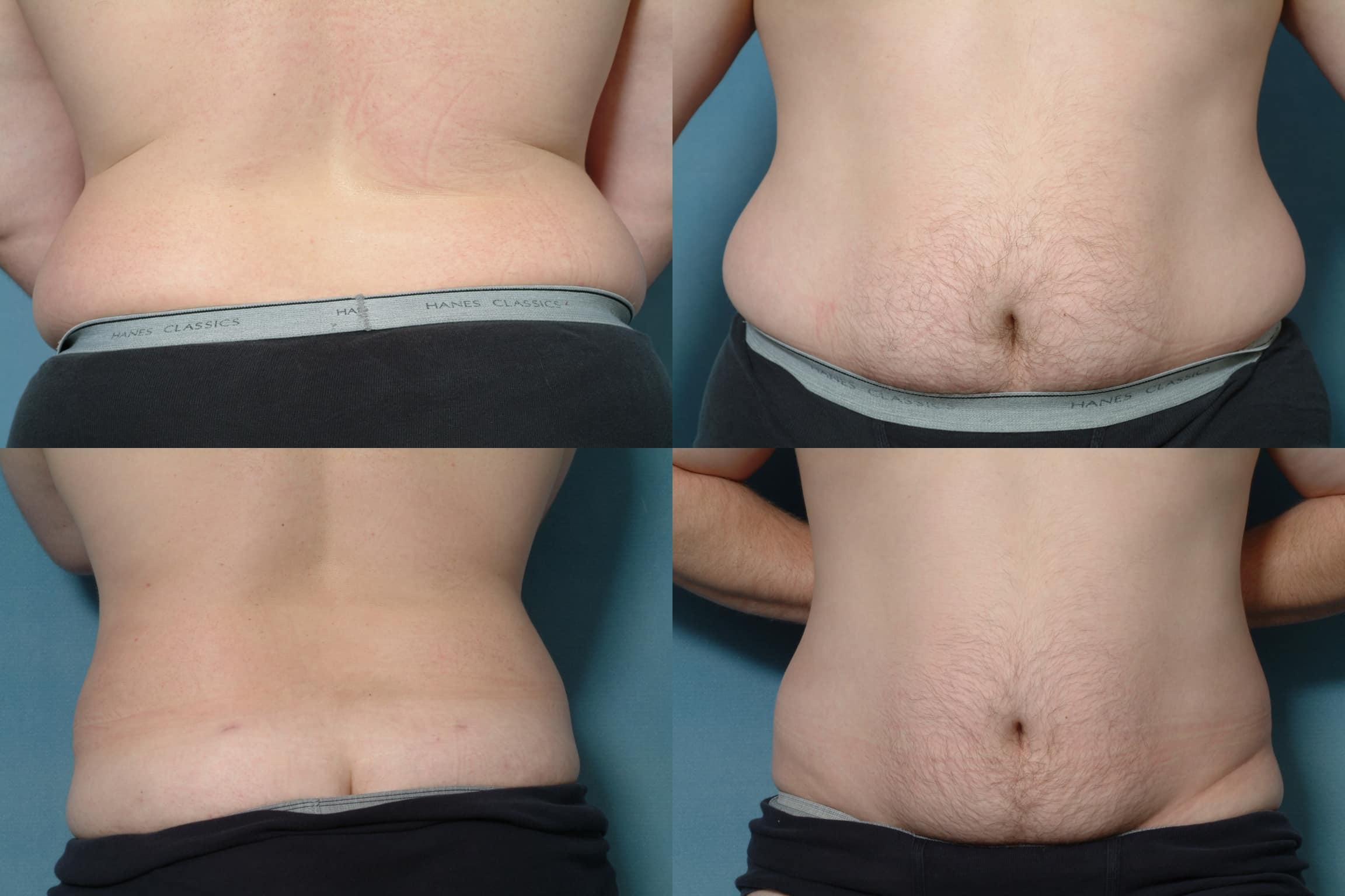 Liposuction Case# 151 Combined Image