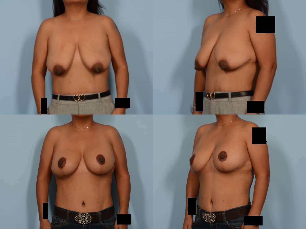 Breast Lift with Augmentation Case# 1166 Combined Image