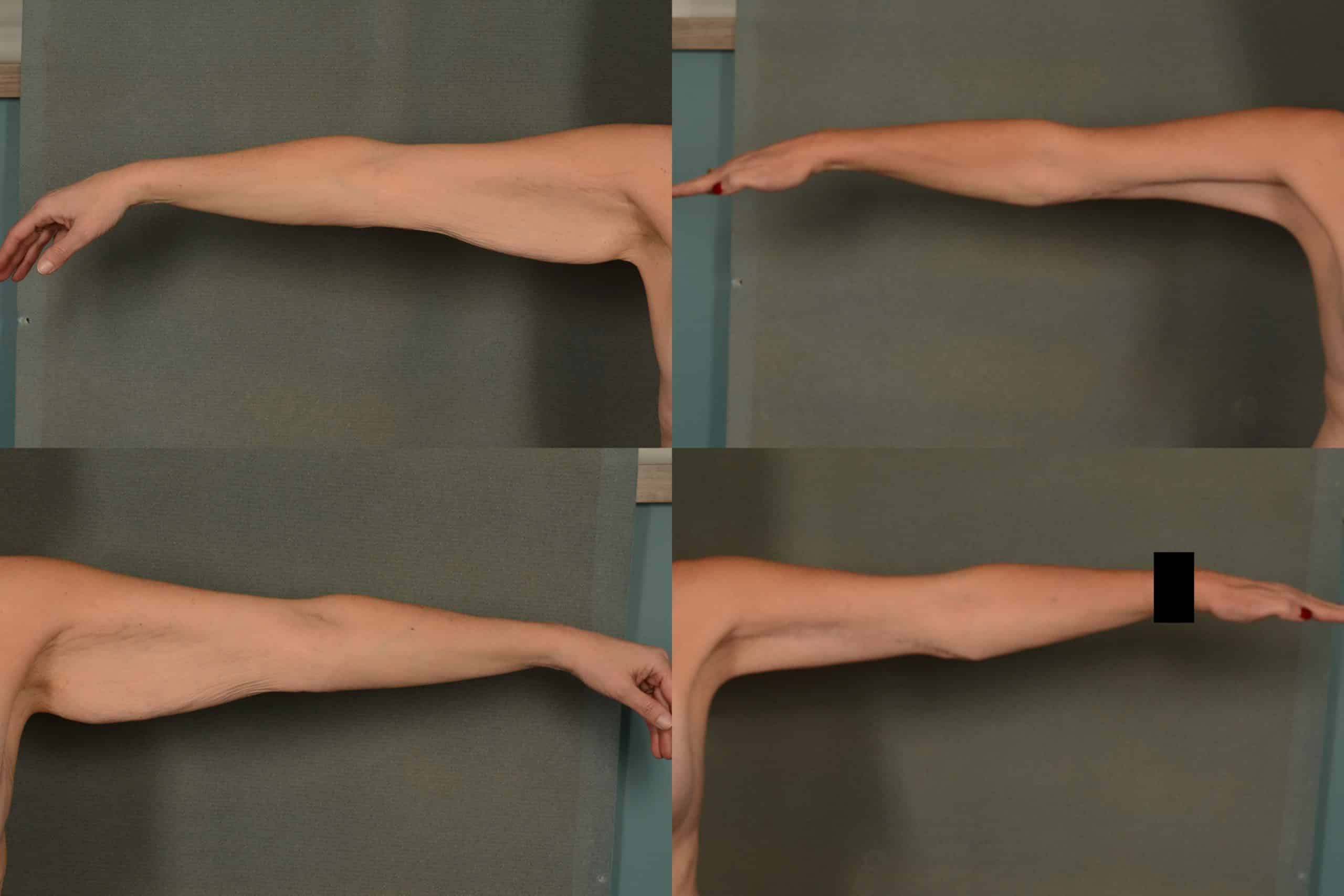 Arm Lift Case# 1007 Combined Image