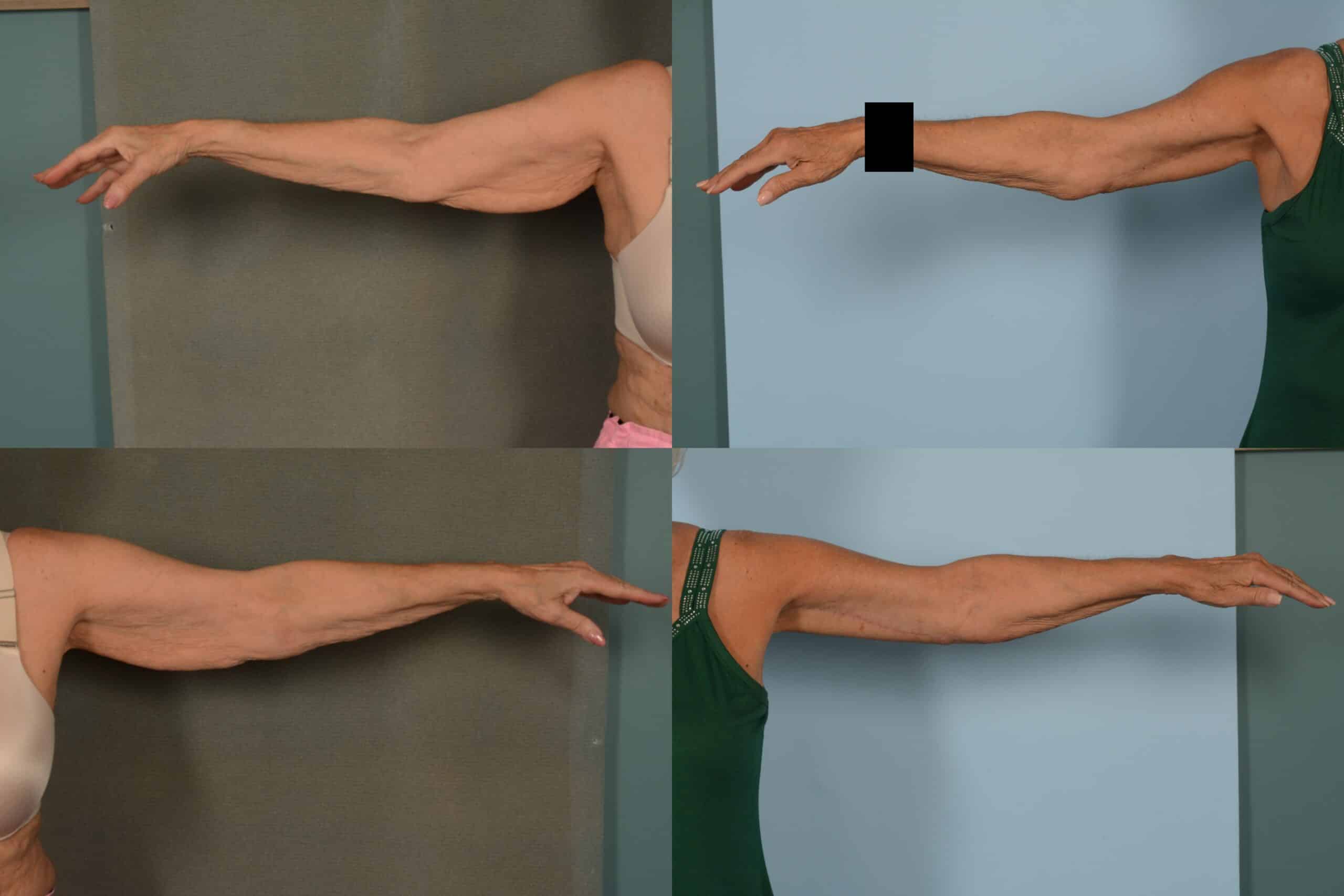 Arm Lift Case# 1098 Combined Image