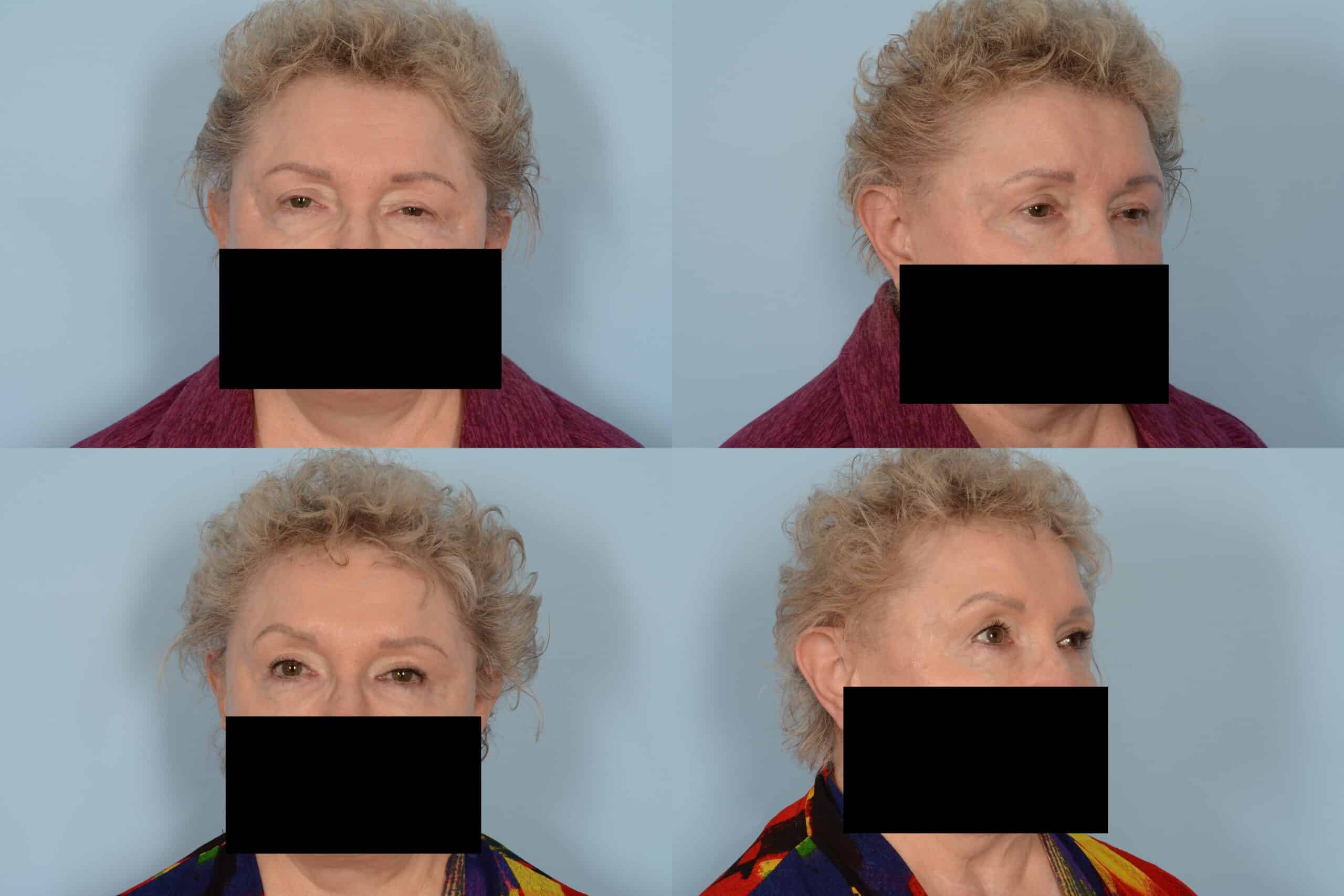 Blepharoplasty Case# 1122 Combined Image