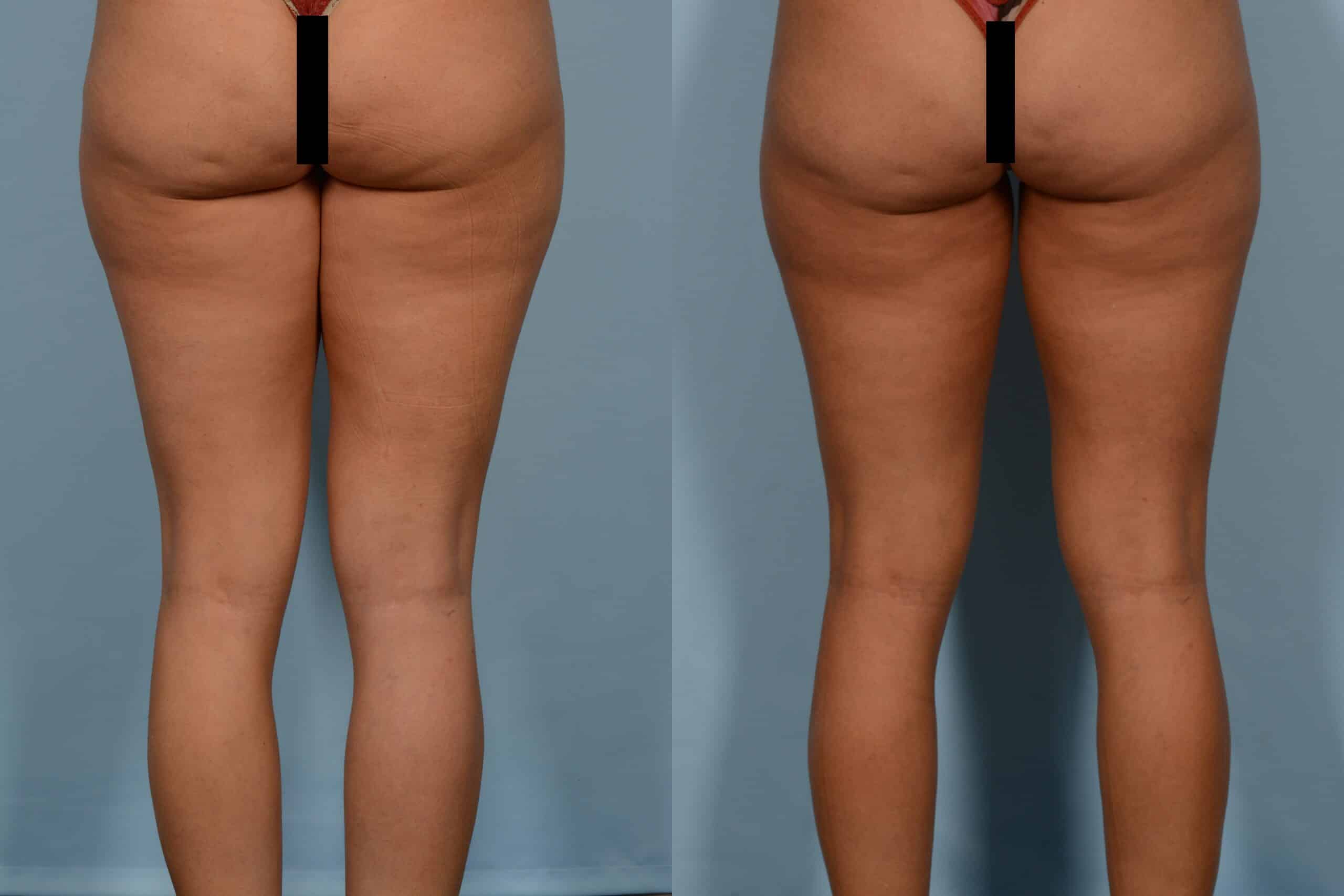 Liposuction Case# 1134 Combined Image