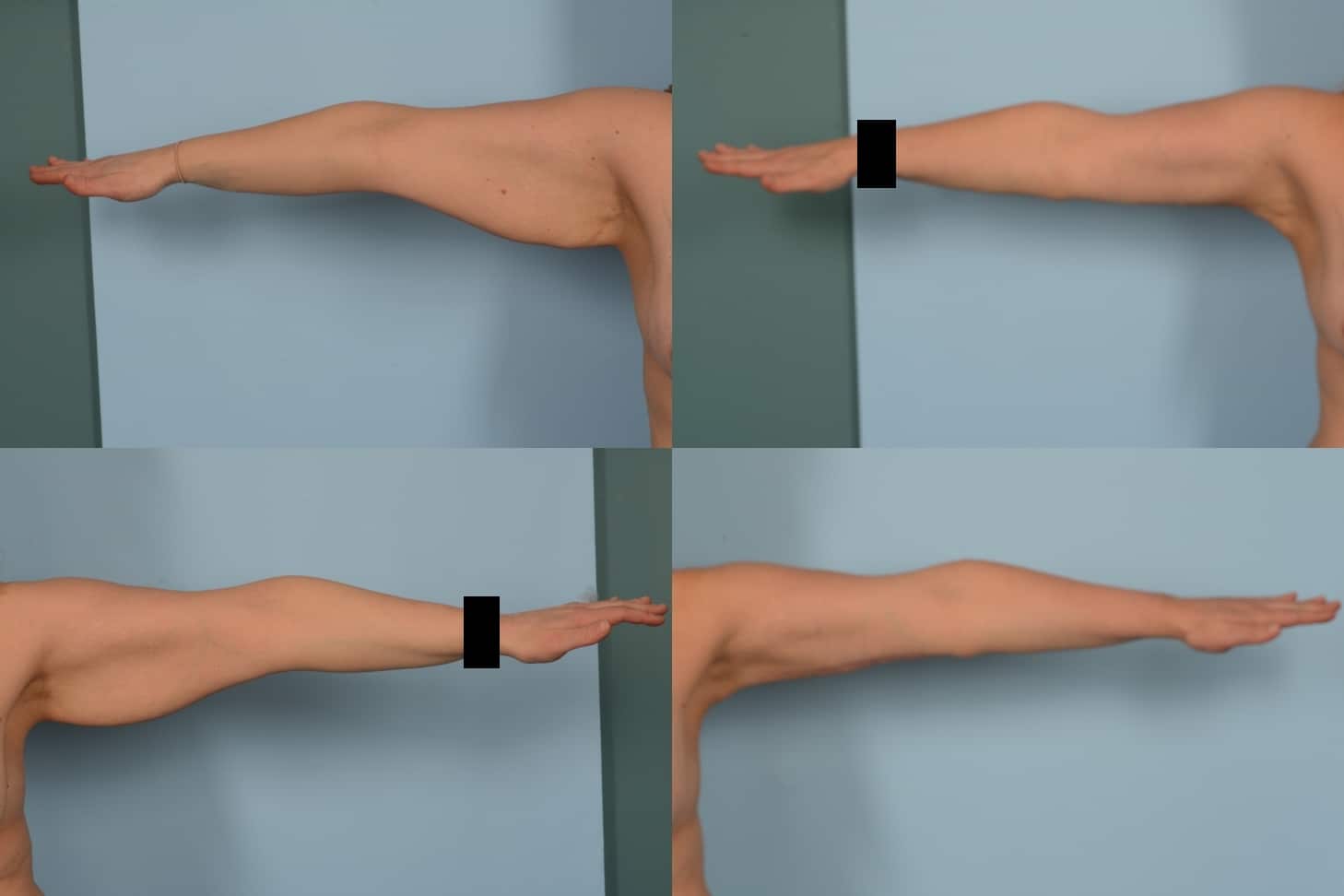 Arm Lift Case# 1153 Combined Image