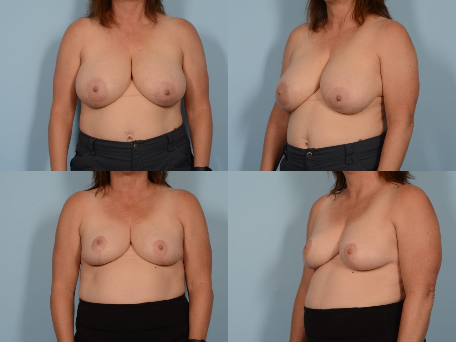 Breast Reduction Case# 1167 Combined Image