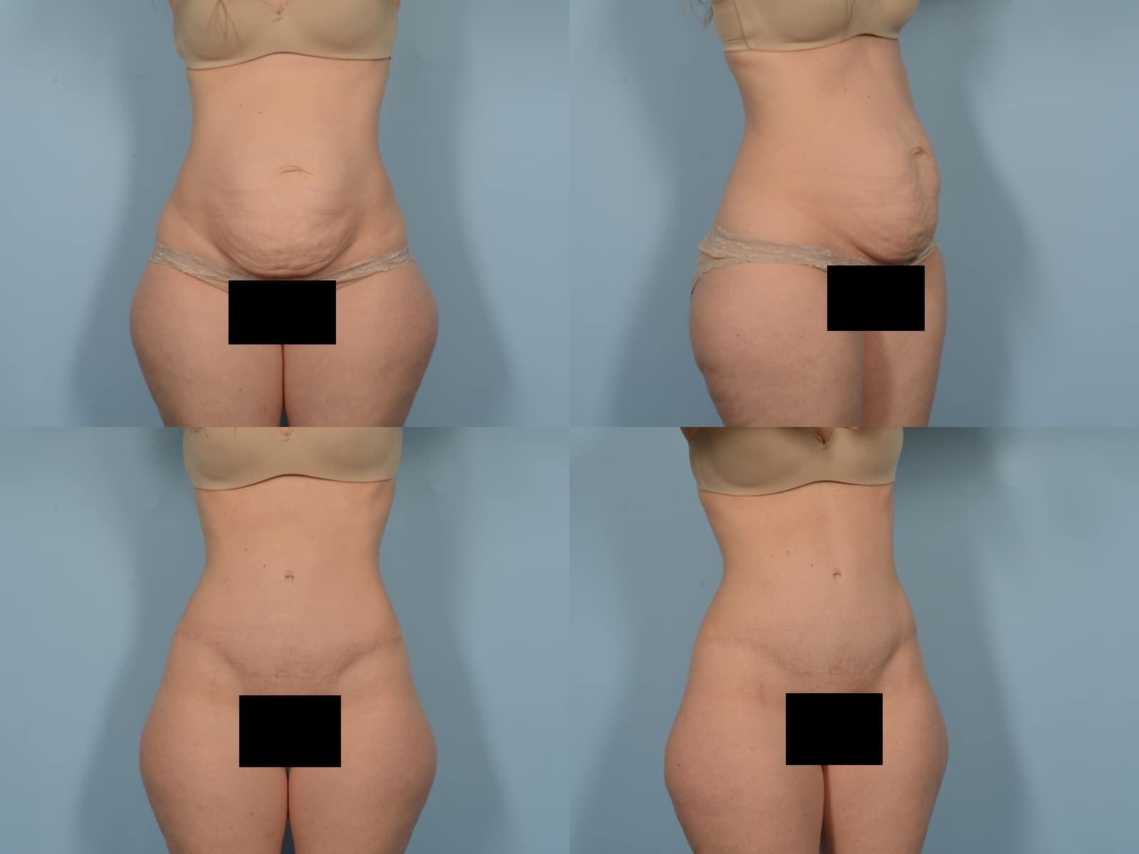 Tummy Tuck Case# 1187 Combined Image