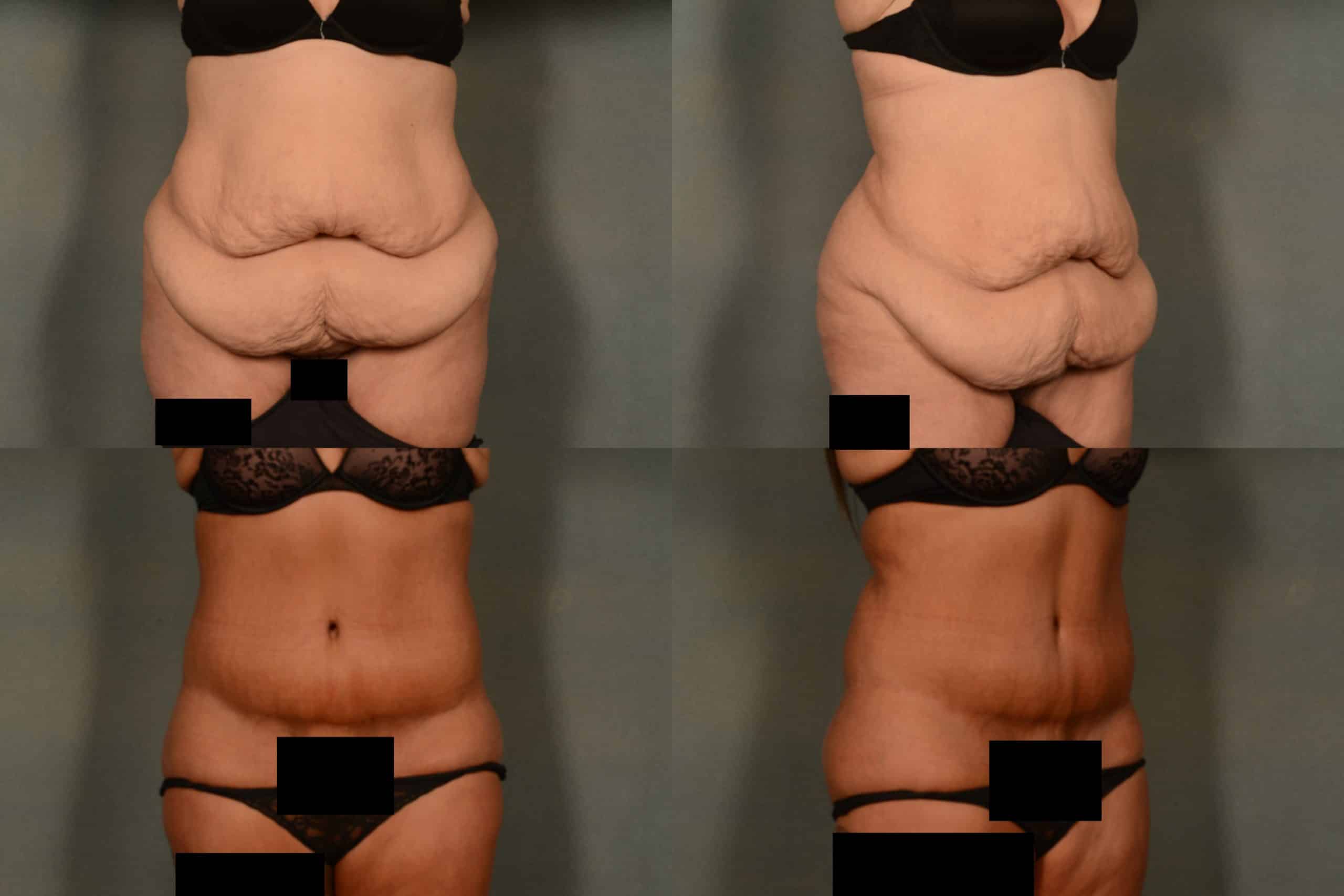 Tummy Tuck Case# 996 Combined Image