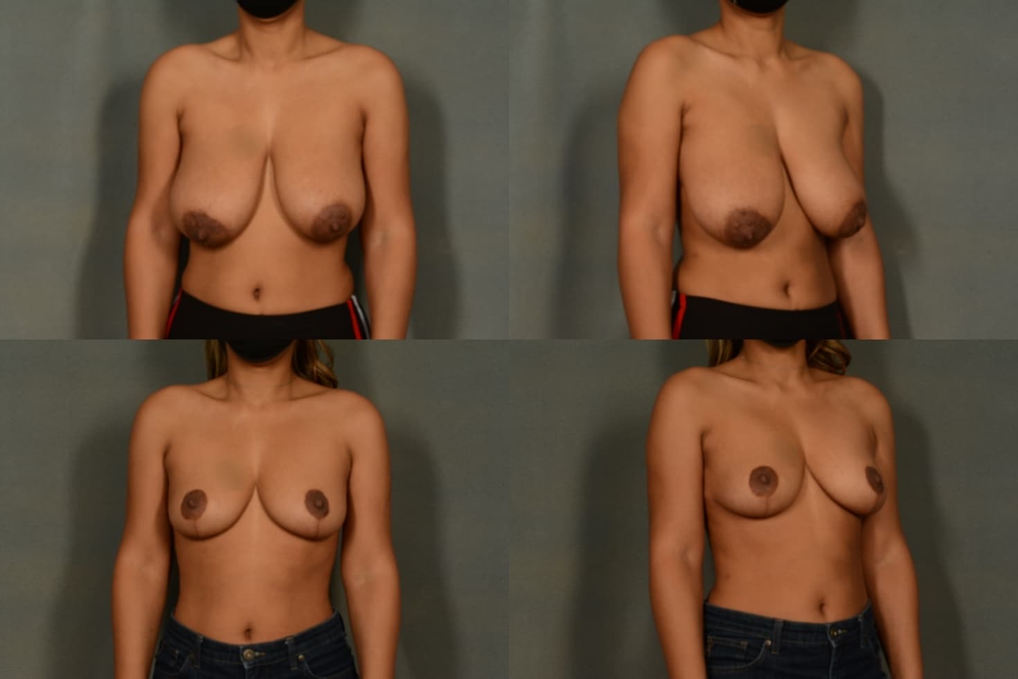 Breast Reduction Case# 1008 Combined Image