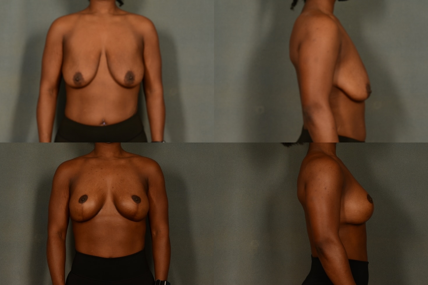 Breast Lift with Augmentation Case# 1029 Combined Image