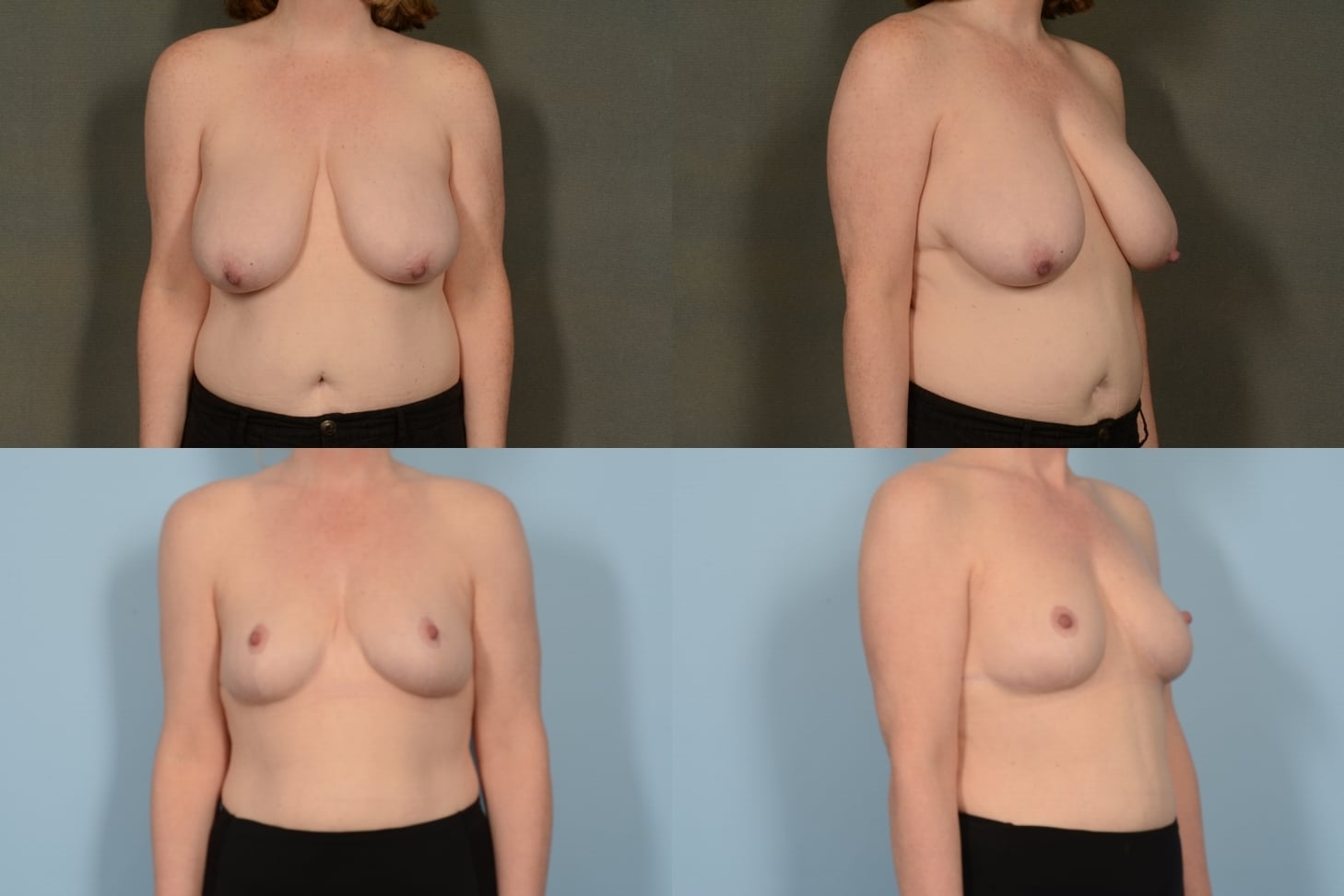 Breast Reduction Case# 1115 Combined Image